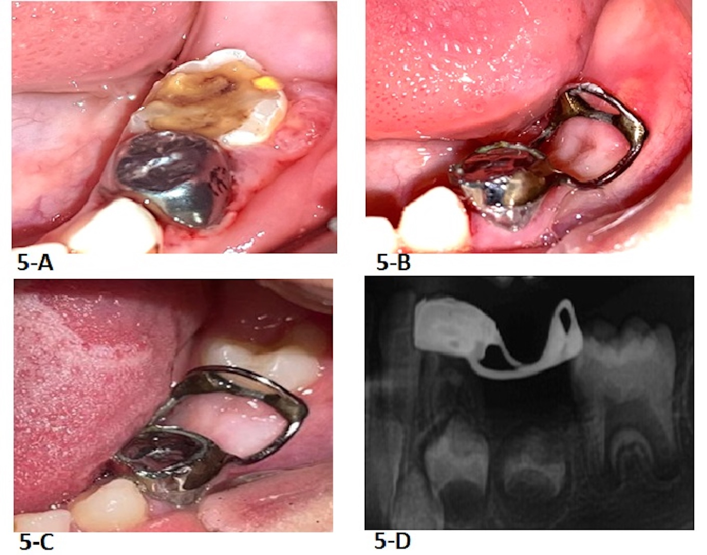 Clinical photos and 
radiograph of the fourth case. (A) Photograph taken in the first appointment. (B) 
Distal guide was delivered. (C) Tooth 19 eruption in its normal path. (D) 
Radiograph shows no mesially migration of tooth 19.