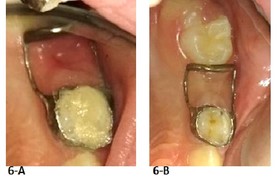 Clinical photos of the 
fifth case. (A) Distal Guide was delivered 3 days after tooth J extraction. (B) 
tooth 14 erupted in normal direction.