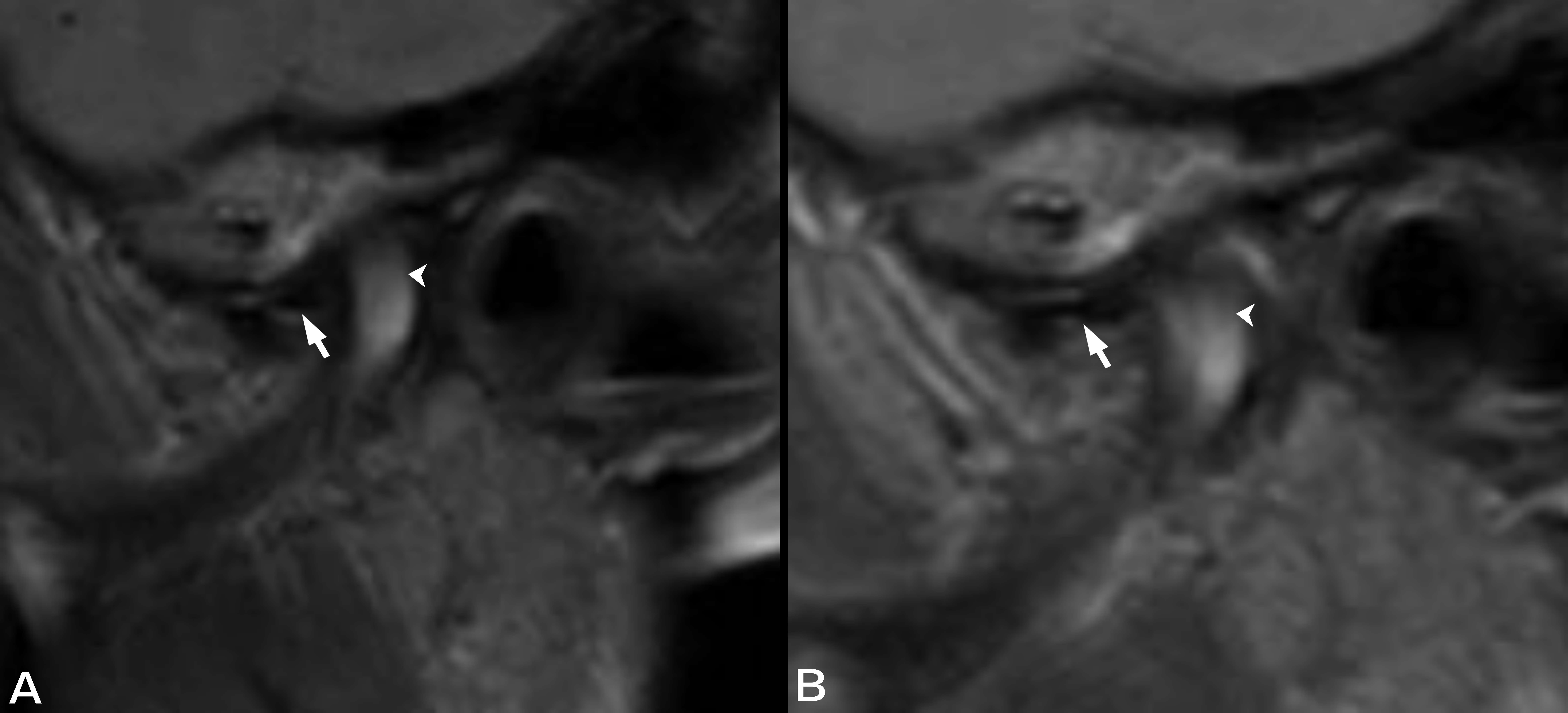 Magnetic resonance imaging 
of 13-year-old girl with left TMJ pain during mouth opening. Sagittal oblique 
proton density image shows anteriorly displaced disc (arrow) of the joint 
(arrowhead) in the (A) closed and the (B) open mouth state.