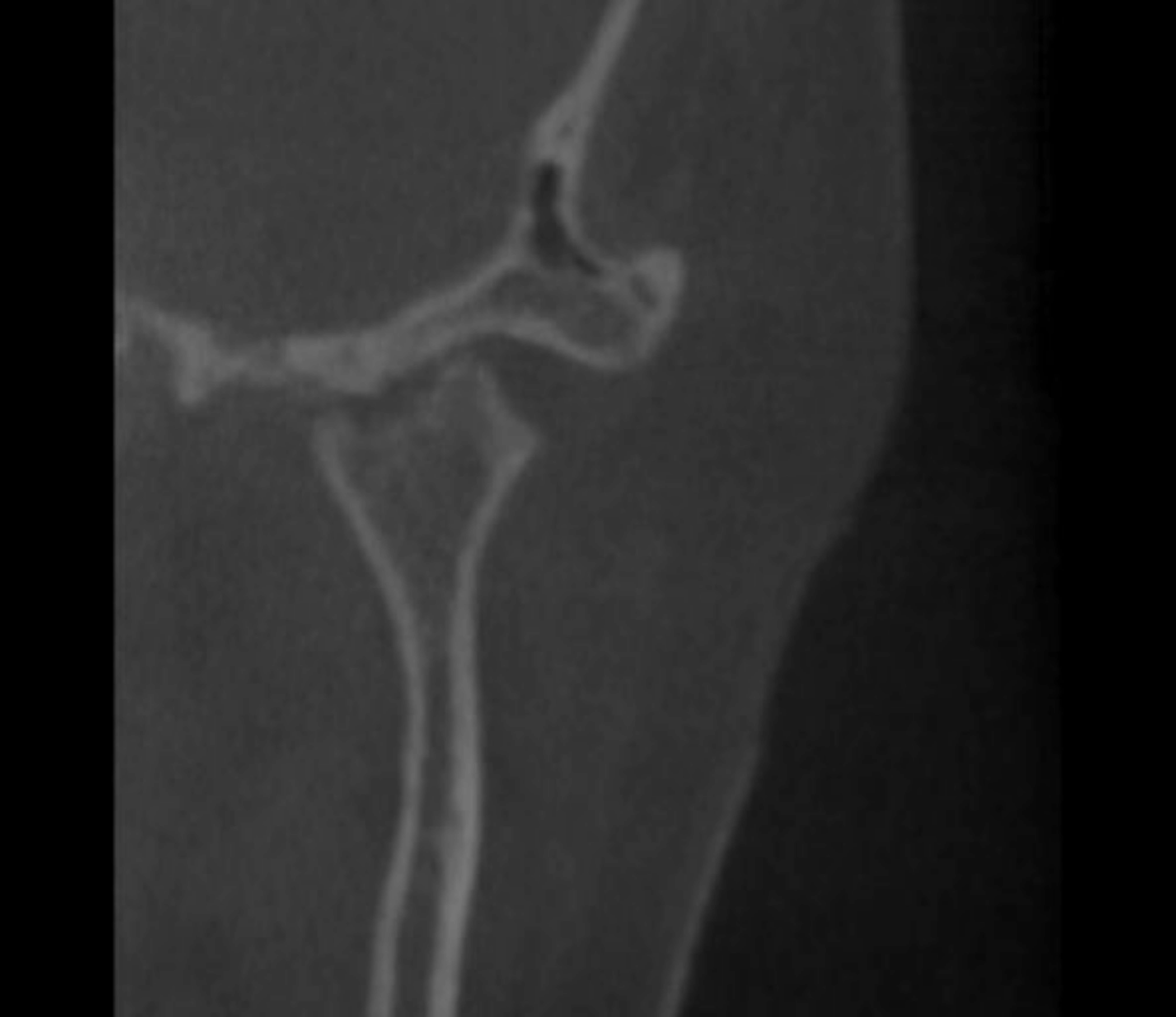 Cone-beam computed 
tomography showing a large defect area and erosion of the left condyle in a 
5-year-old child with trauma to the maxillary primary teeth.