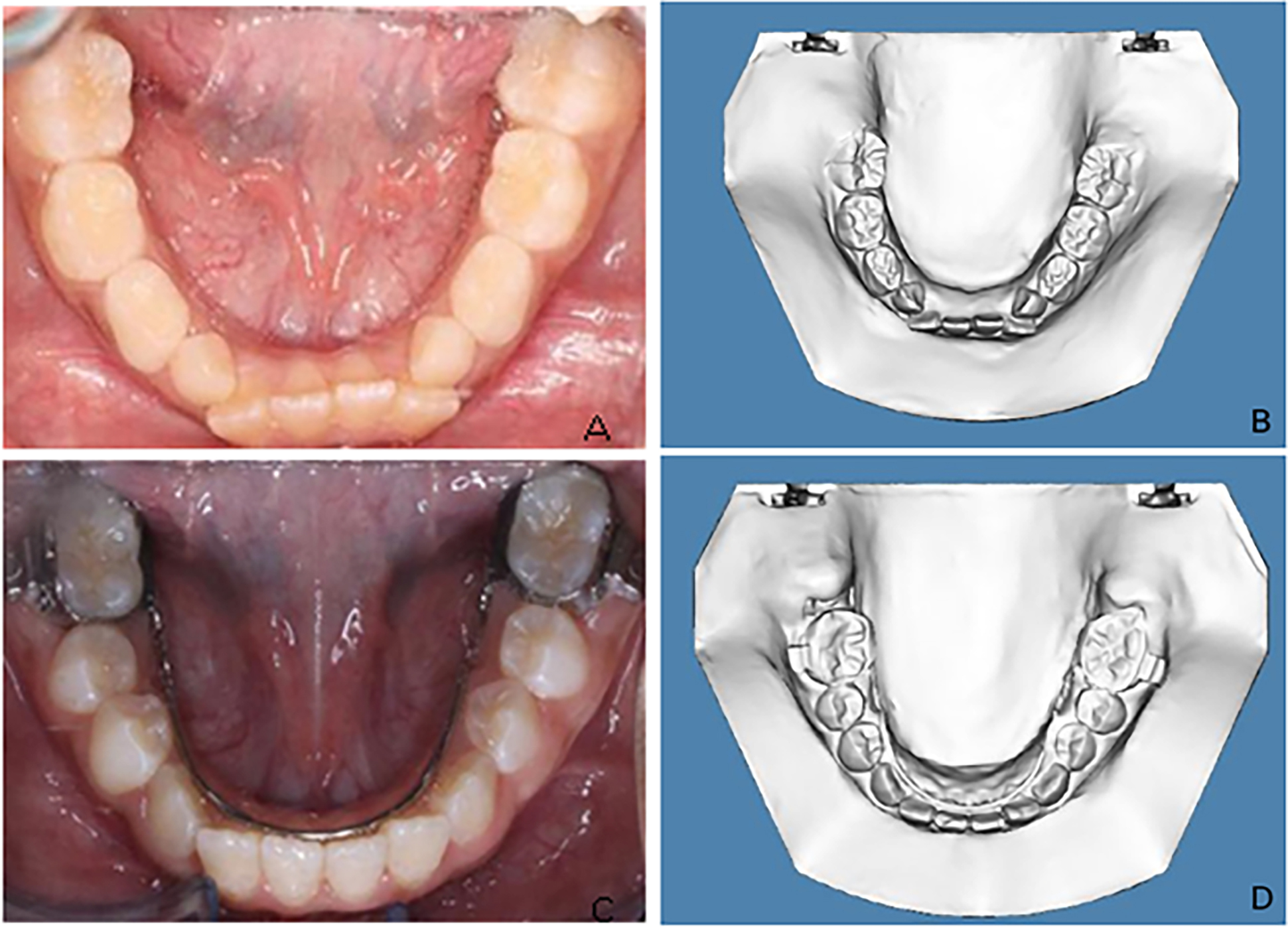 Case 1. (A) Intraoral pre-treatment photograph of
mandibular arch. (B) Pre-treatment digital study cast displaying the mandibular
incisor crowding. (C) Intraoral post-treatment photograph of mandibular arch. (D)
Post-treatment digital study cast with LLHA.