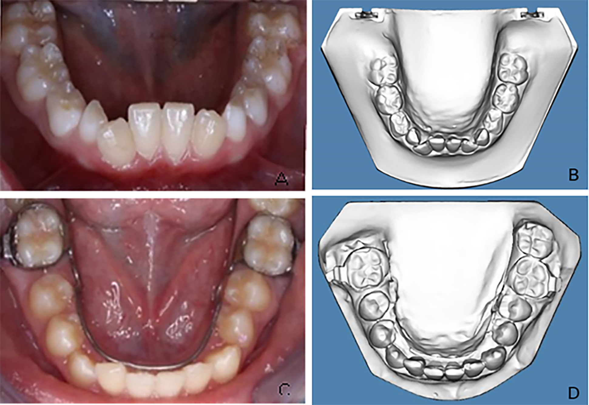 Case 2. (A) Intraoral pre-treatment
photograph of mandibular arch. (B) Pre-treatment digital study cast displaying
the mandibular incisor crowding. (C) Intraoral post-treatment photograph of
mandibular arch. (D) Post-treatment digital study cast with LLHA.