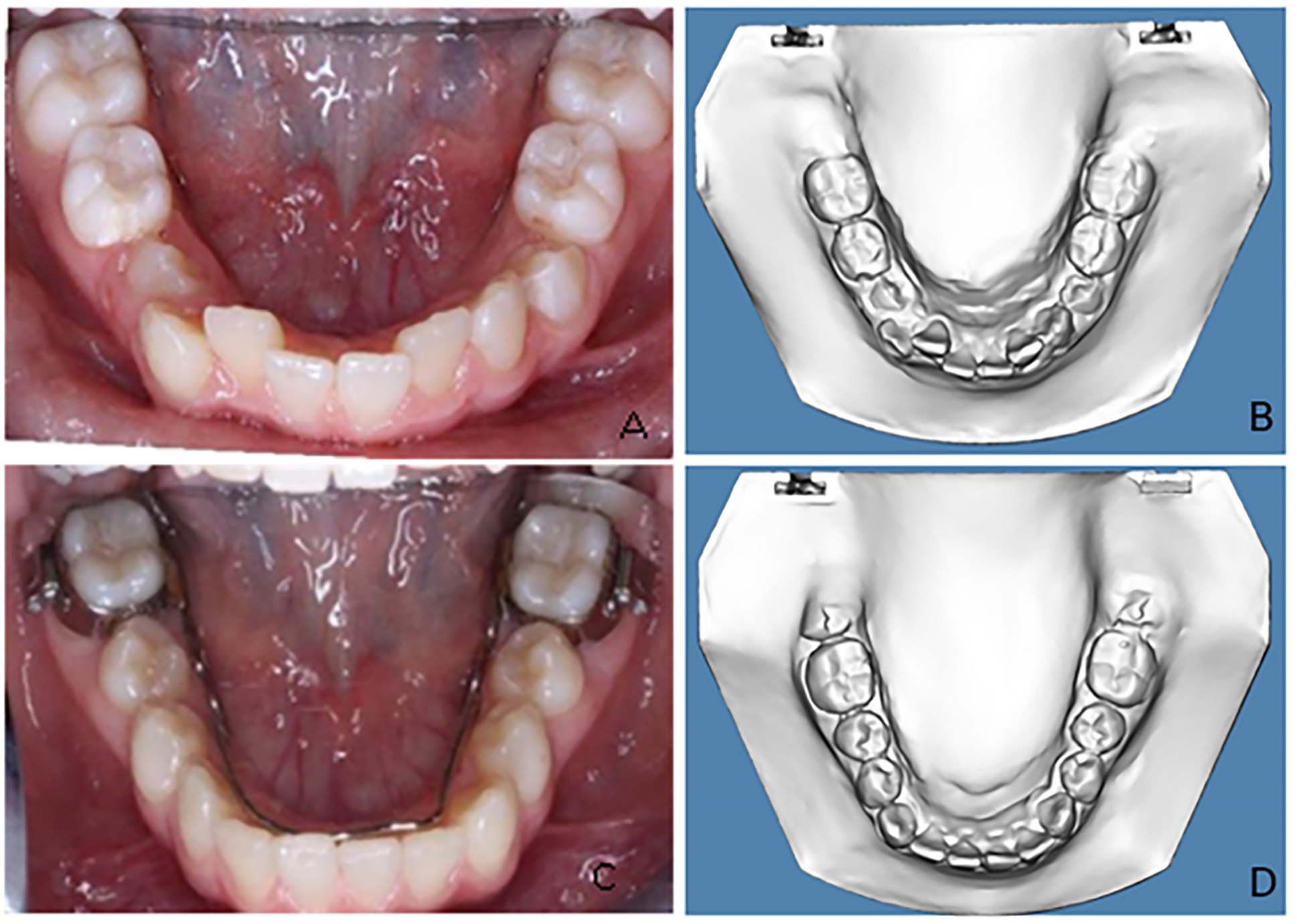 Case 3. (A) Intraoral pre-treatment photograph of
mandibular arch. (B) Pre-treatment digital study cast displaying the mandibular
incisor crowding. (C) Intraoral post-treatment photograph of mandibular arch. (D)
Post-treatment digital study cast immediately after removal of the LLHA.