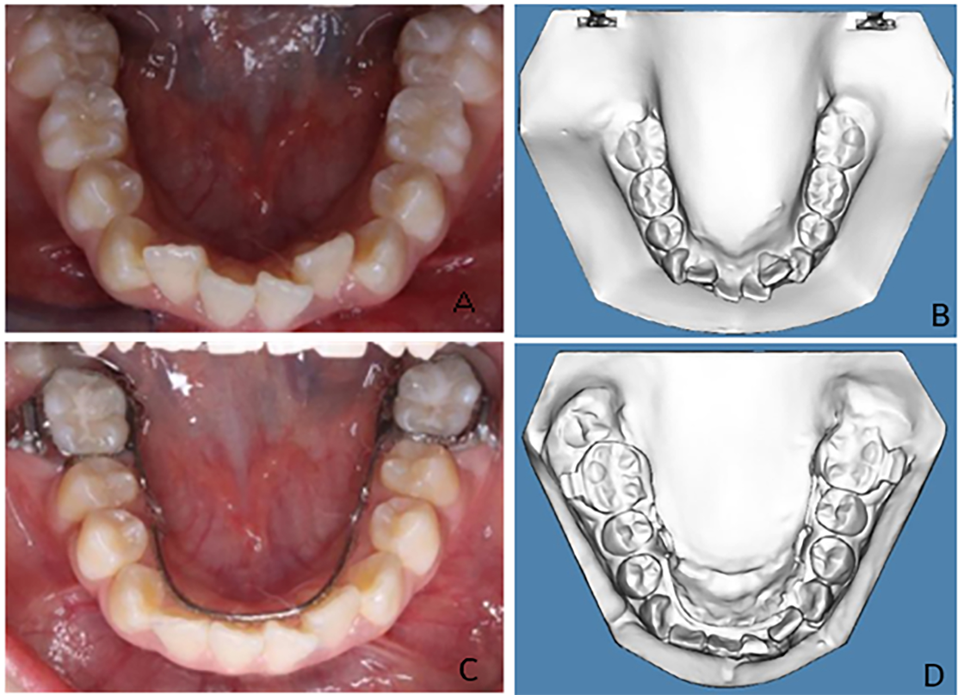 Case 4. (A) Intraoral pre-treatment
photograph of mandibular arch. (B) Pre-treatment digital study cast displaying
the mandibular incisor crowding. (C) Intraoral post-treatment photograph of
mandibular arch. (D) Post-treatment digital study cast with LLHA.