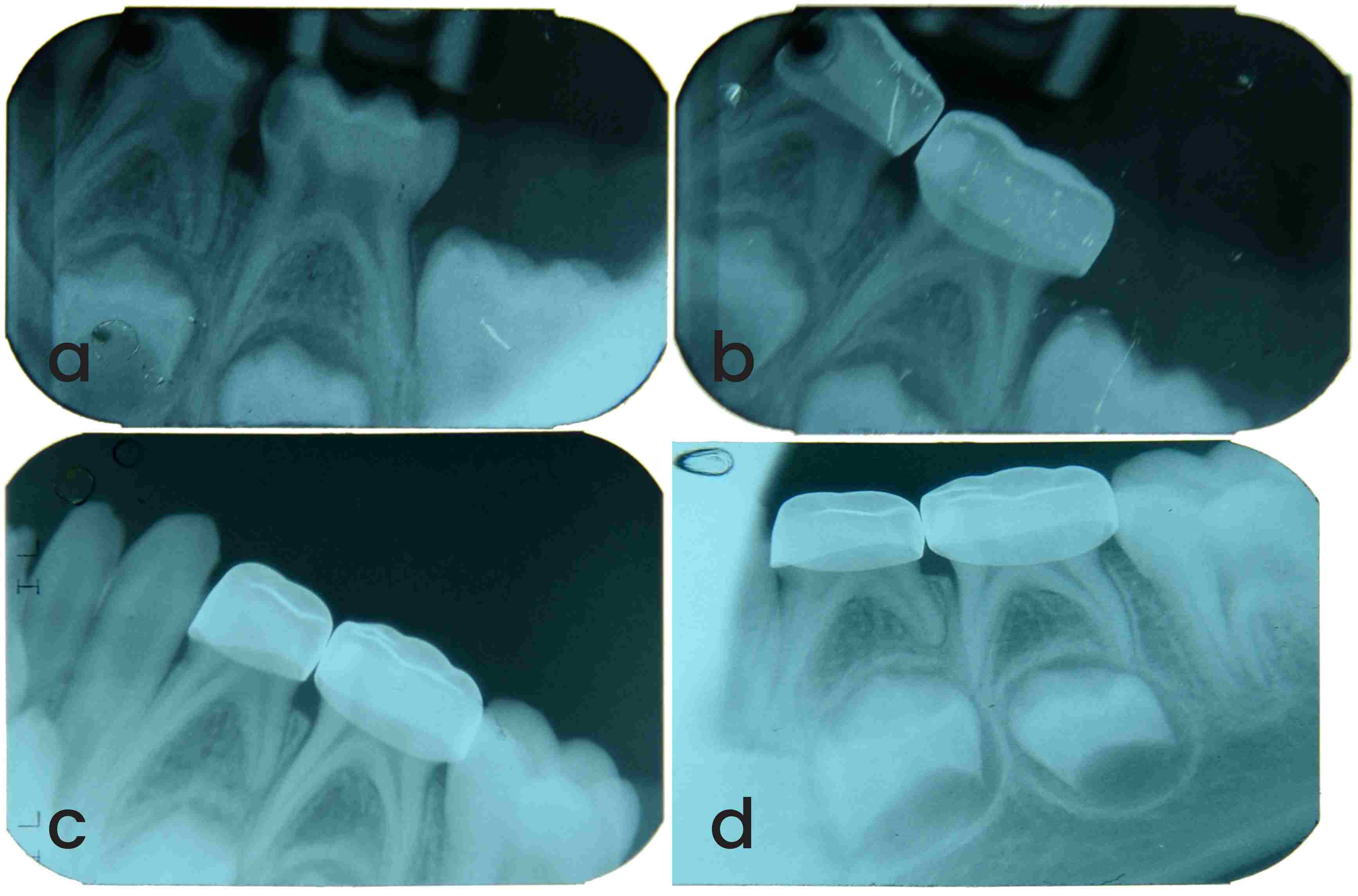 Clinical procedure for indirect pulp capping. (A) Rubber dam