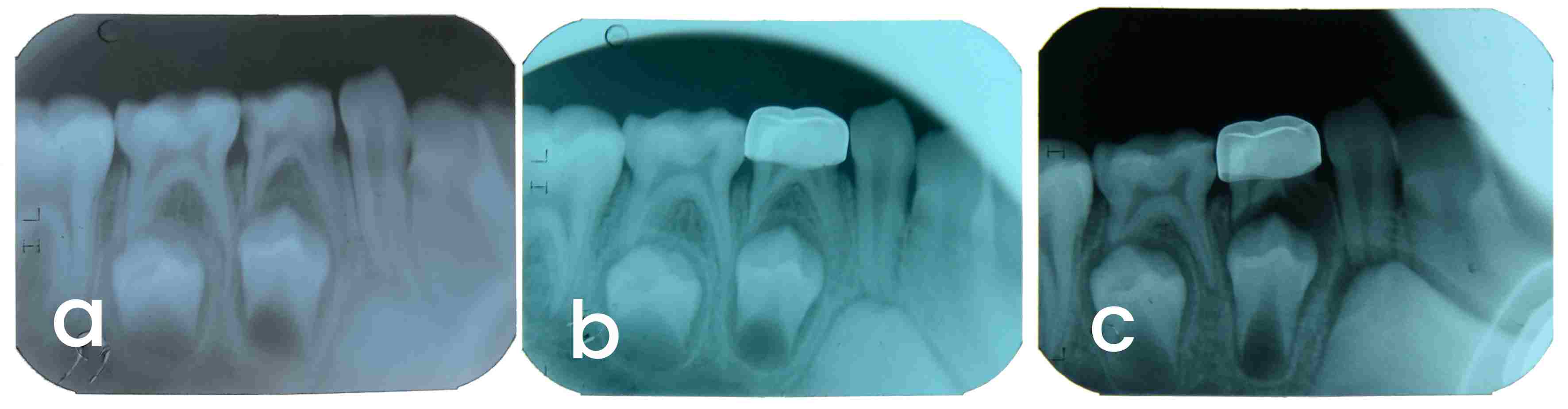 DPC in a mandibular first 
primary molar. (a) preoperative, (b) postoperative, (c) 6 months (ERR).