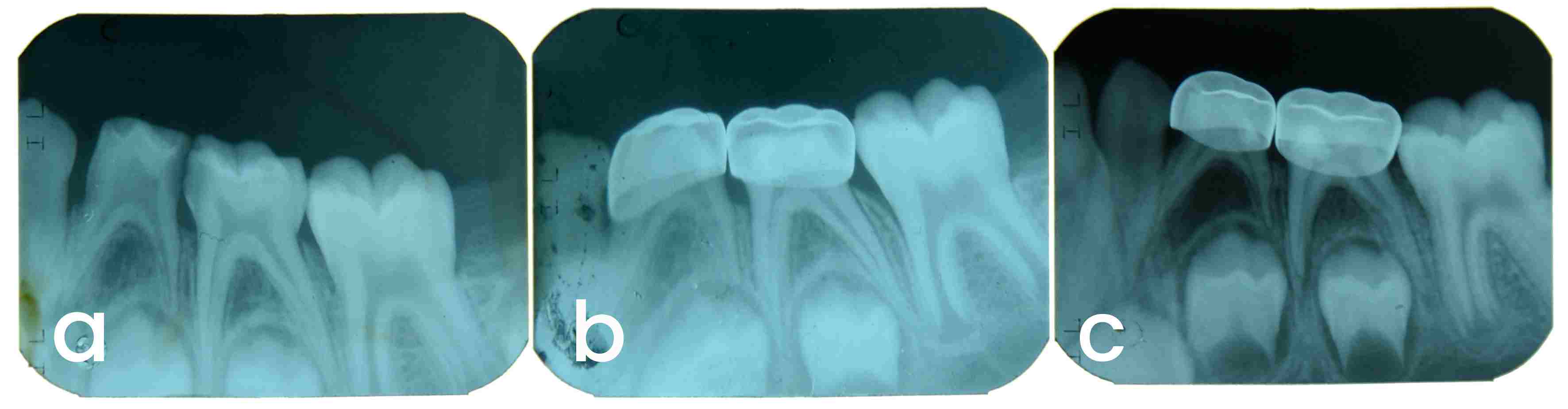 PP in mandibular first and 
second primary molars. (a) Preoperative, (b) postoperative, (c) 6 months 
(furcation involvement in first primary molar, widening of periodontal membrane 
space associated with spontaneous pain in second primary molar).
