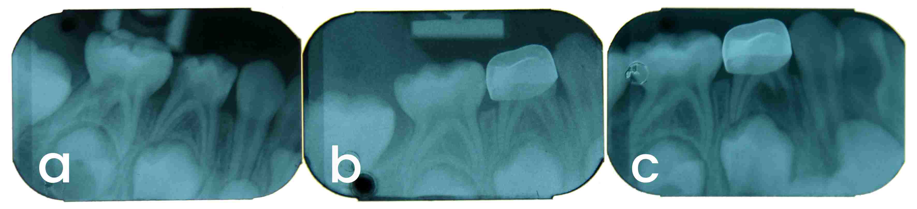 PP in a mandibular first 
primary molar. (a) Preoperative, (b) 6 months (IRR in mesial root), (c) 12 months 
(progressive IRR in mesial root).