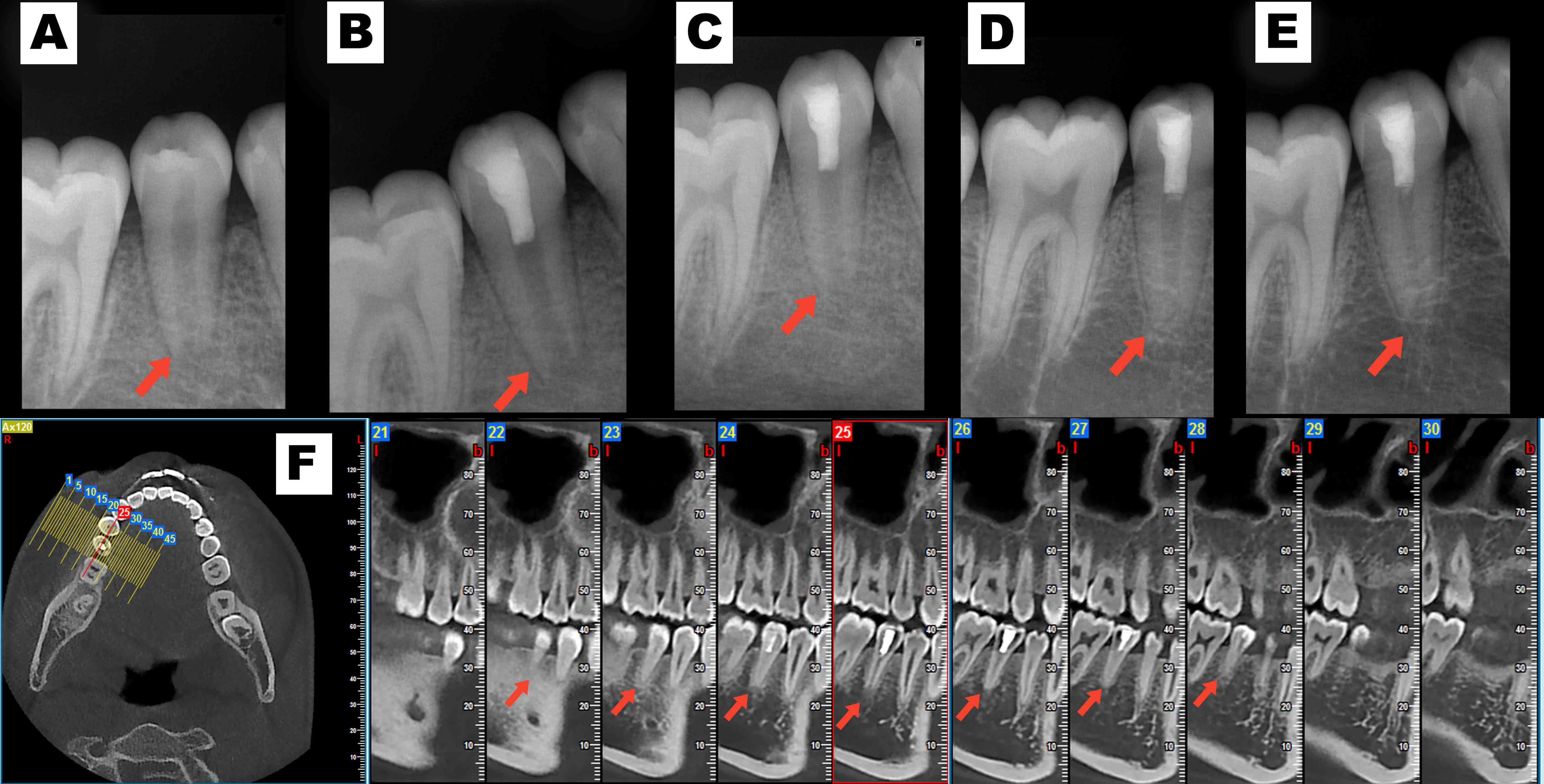 Radiographs of teeth in the control group obtained. (A)
preoperatively. (B) 6 months post-therapy. (C) 12 months post-therapy. (D) 18
months post-therapy, and (E) 24 months post-therapy after 24 months of pulp
regenerative therapy. (F) Cone-beam computed tomography images 24 months after
therapy.