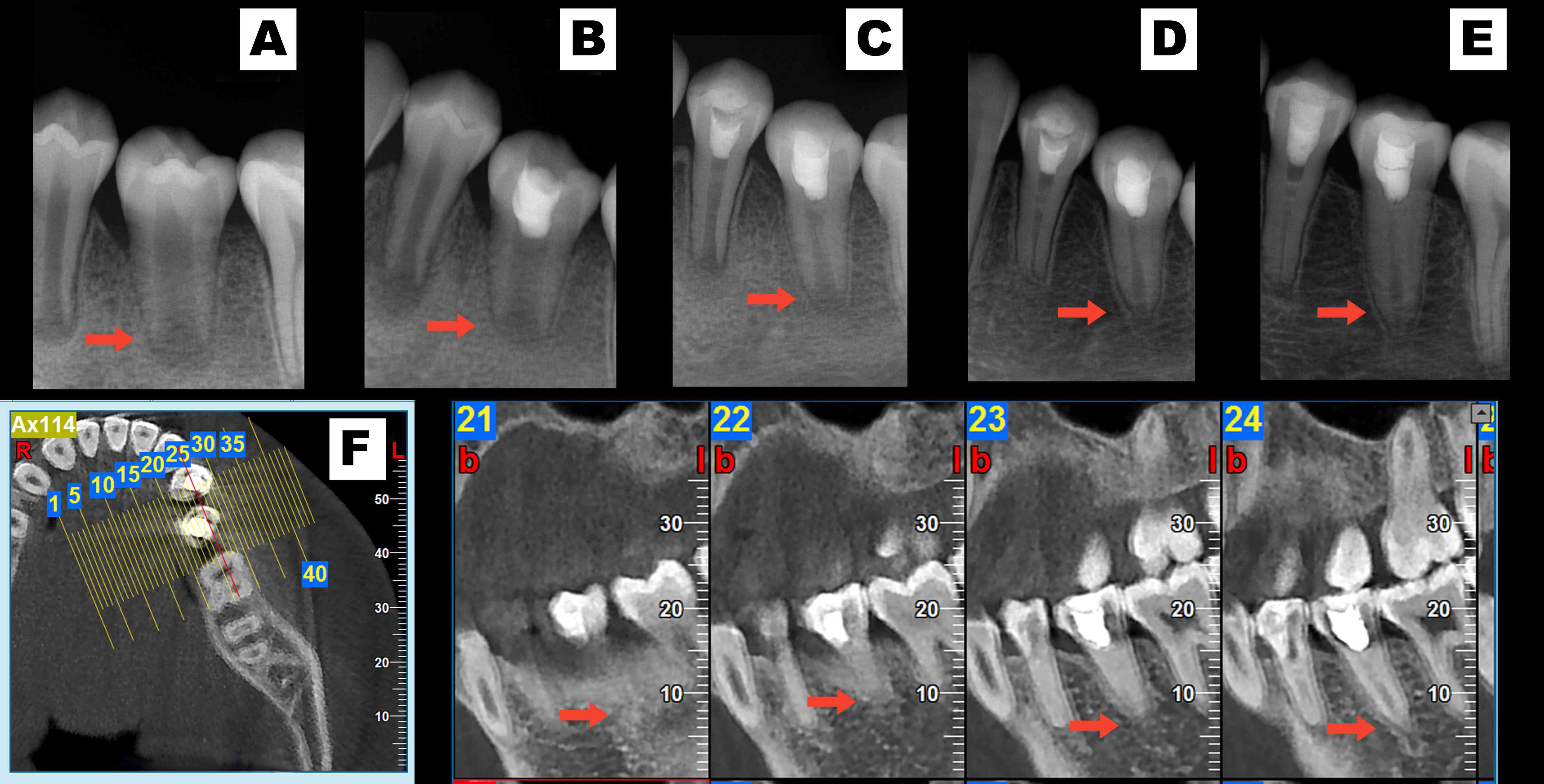 Radiographs of teeth in the experimental group. (A)
preoperatively. (B) 6 months post-therapy. (C) 12 months post-therapy. (D) 18
months post-therapy, and (E) 24 months post-therapy after 24 months of pulp
regenerative therapy. (F) Cone-beam computed tomography images 24 months after
therapy.