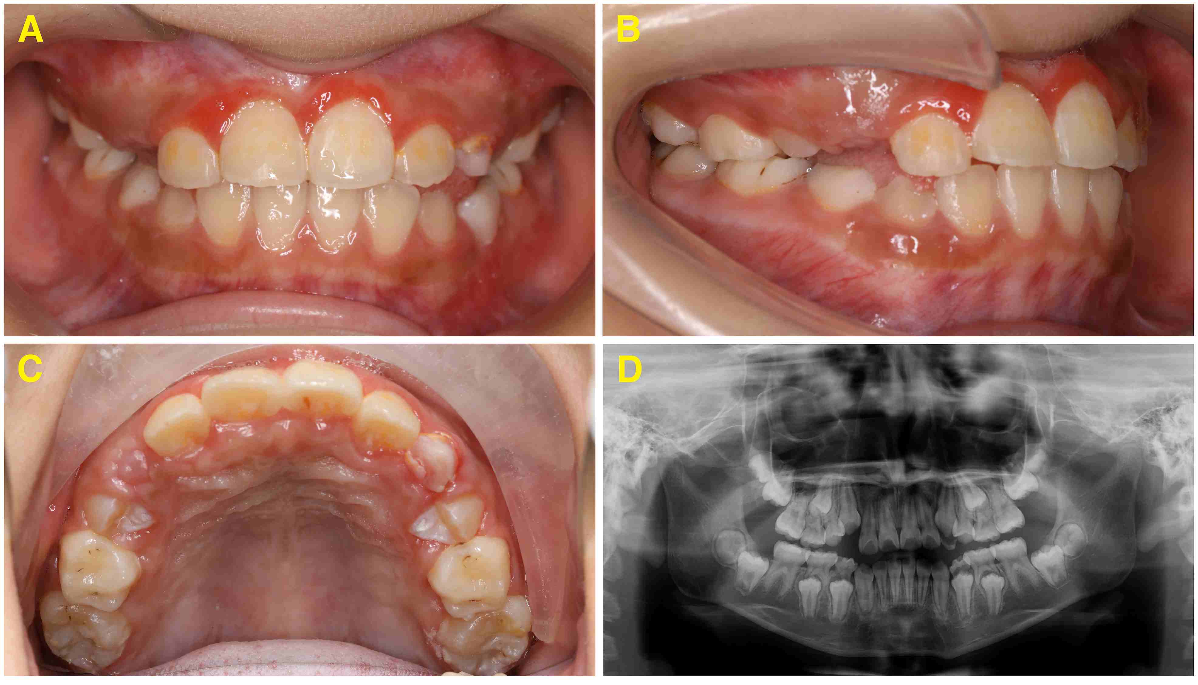 Comparison of dental anomalies between the groups with impacted