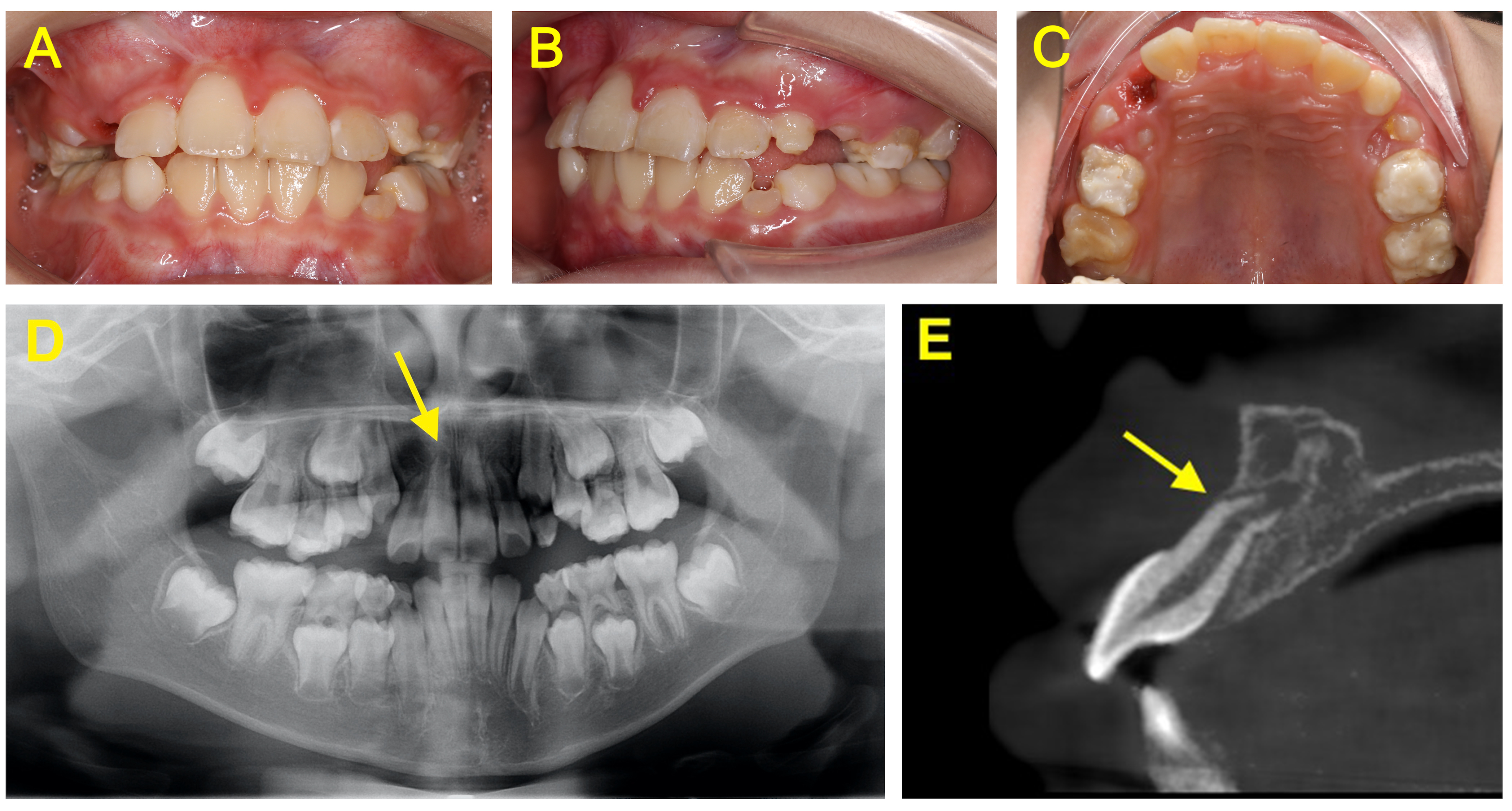 Comparison of dental anomalies between the groups with impacted