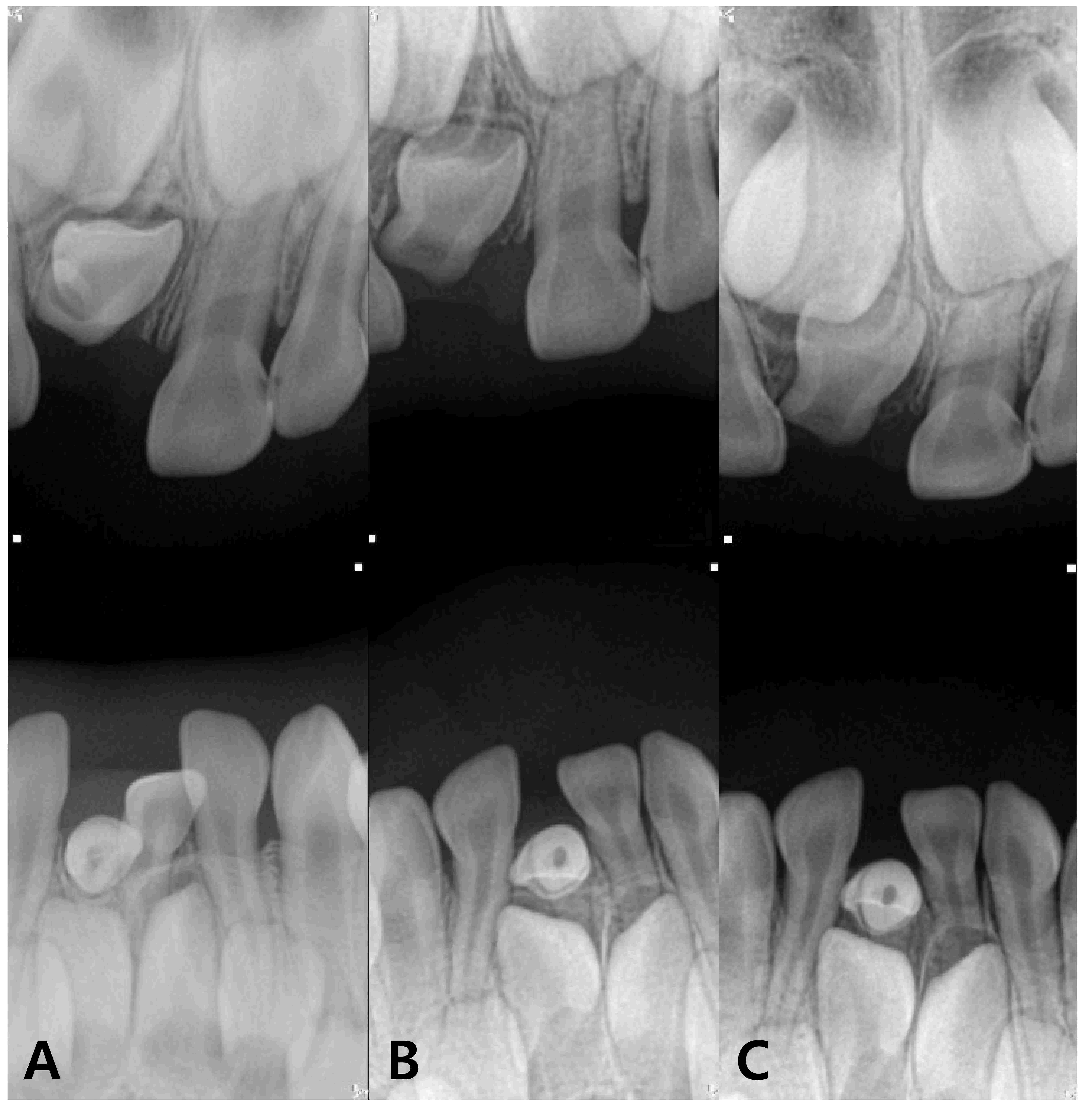 Periapical radiograph of
the primary incisors. (A) Lingual eruption of tooth #71 (3Y 3M). (B) Tooth #71
spontaneously fully erupted (4Y 7M). (C) Movement of the successive permanent
teeth #11 and #41 in the alveolar bone (5Y 1M).