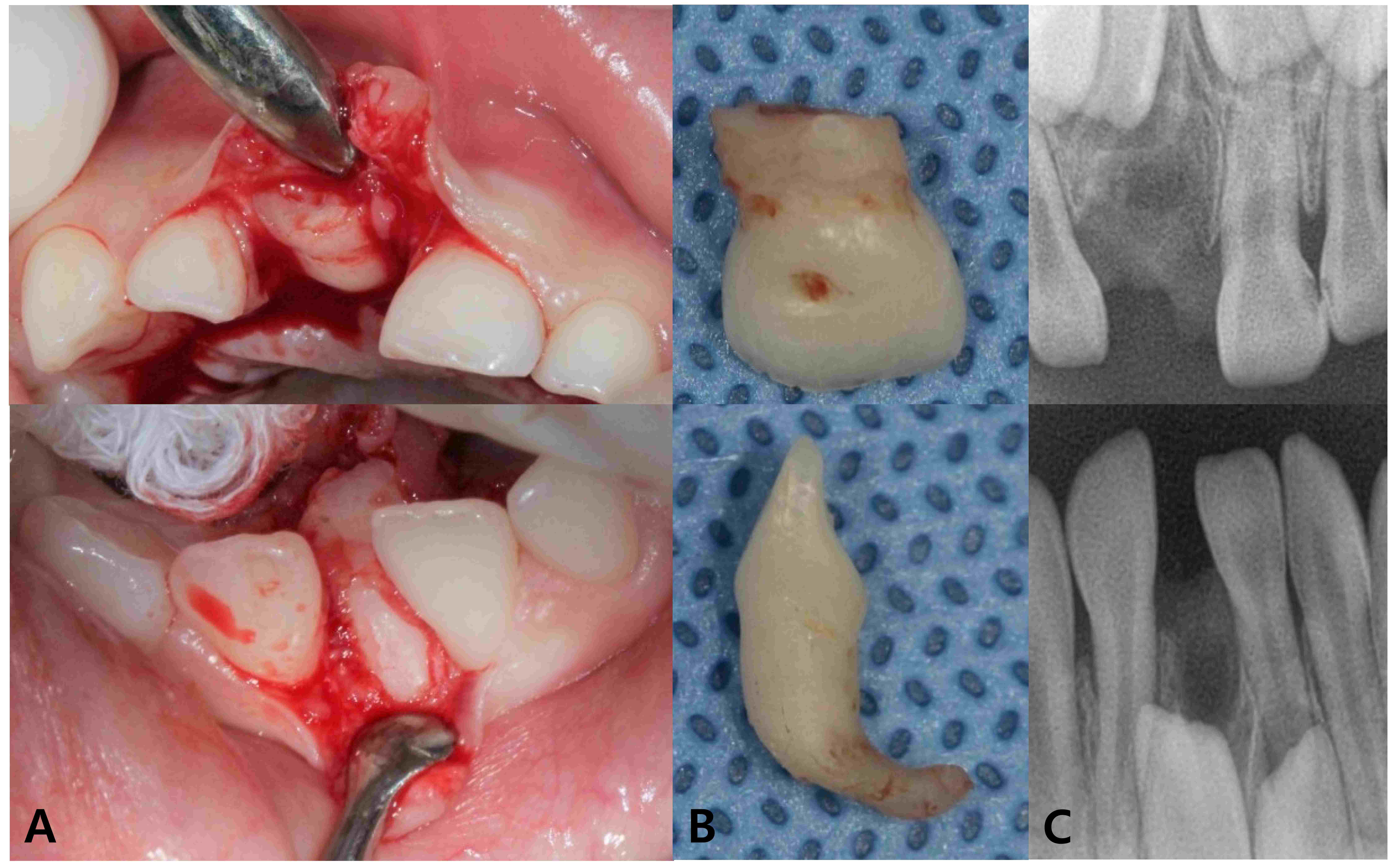 Extraction of impacted
teeth #51 and #81 under general anesthesia. (A) Teeth #51 and #81 were
displaced to the palatal and lingual sides, respectively. (B) Crown and root
shapes of teeth #51 and #81. (C) Periapical radiograph after extraction.