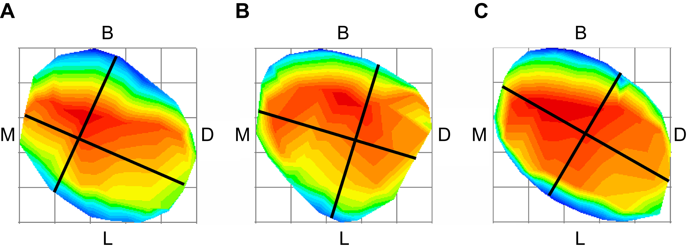 Classifications of mandibular primary first molars according to
their occlusal morphological features. Class A refers to mandibular primary first
molars, wherein the mesiodistal (MD) and buccolingual (BL) lines intersect near
the lingual side; Class B represents the molars in which the intersection is near
the buccal side, and Class C represents the molars in which the intersection is
almost at the center.