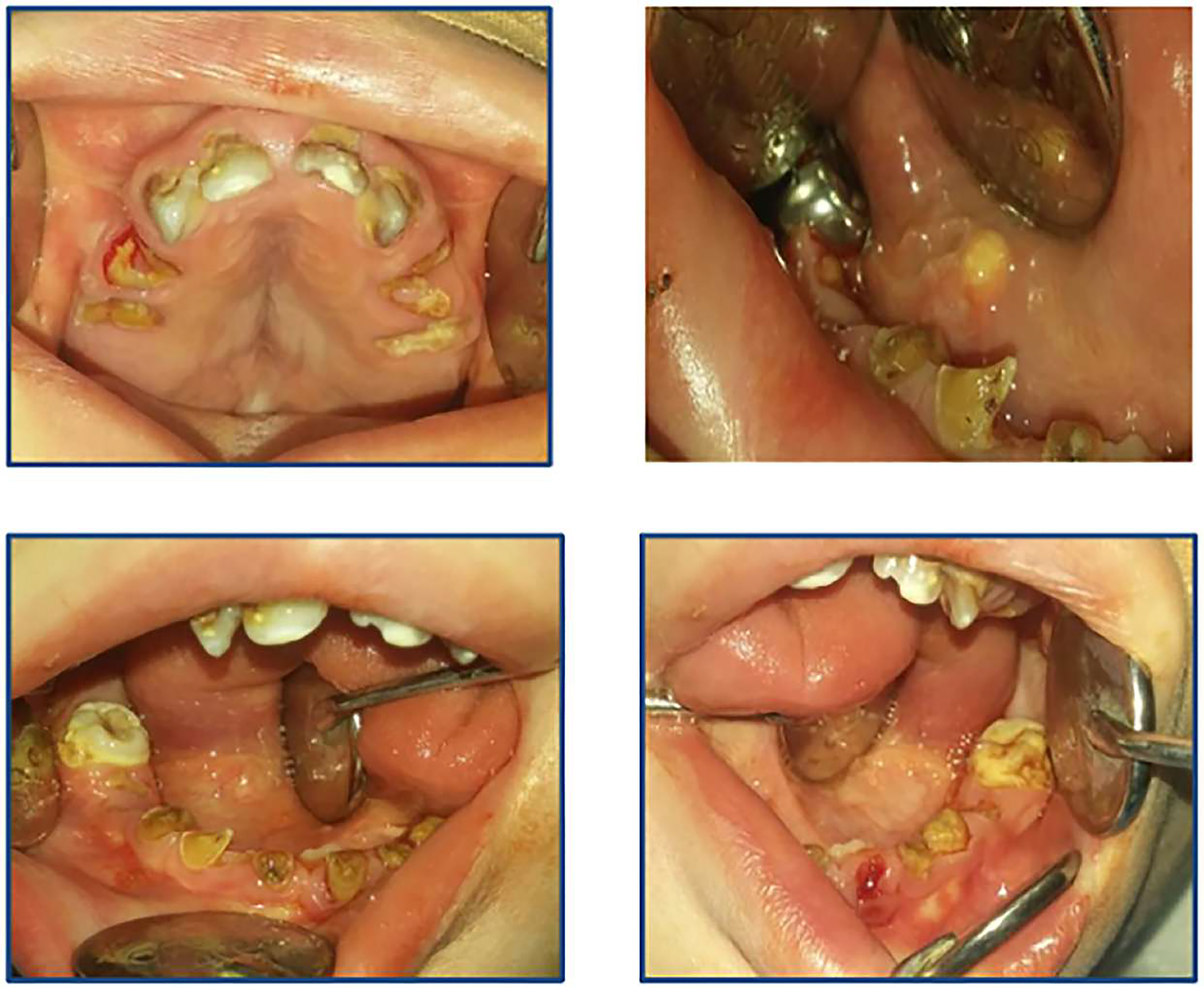 Severe caries lesions, 
hypocalcified areas on the primary teeth, missing upper primary lateral incisors, 
gingival inflammation-associated swelling and erythema, deep and dome-shaped 
palate, cleft submucous palate and a mass on the floor of the mouth.