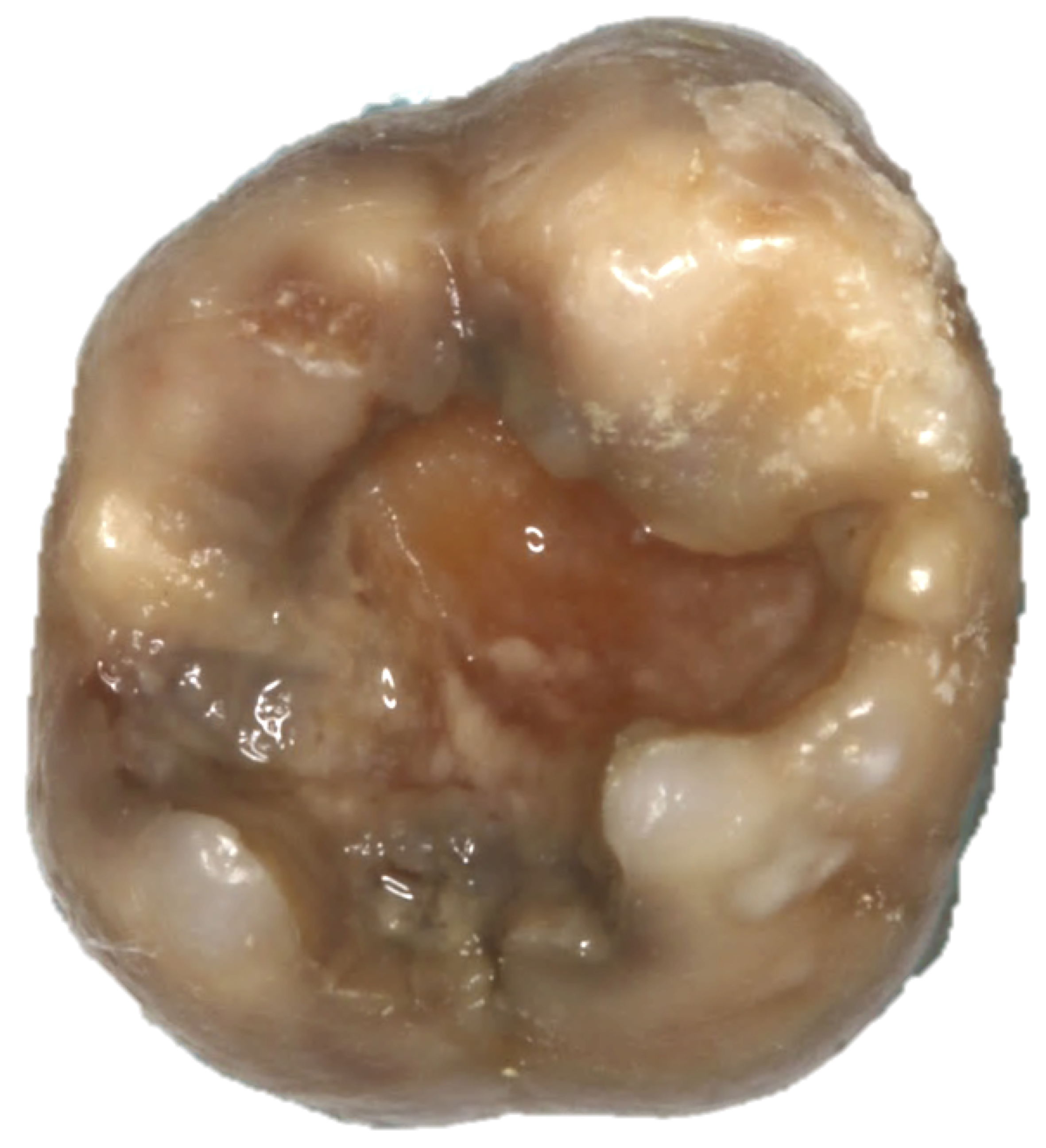 An example of severe form of MIH.