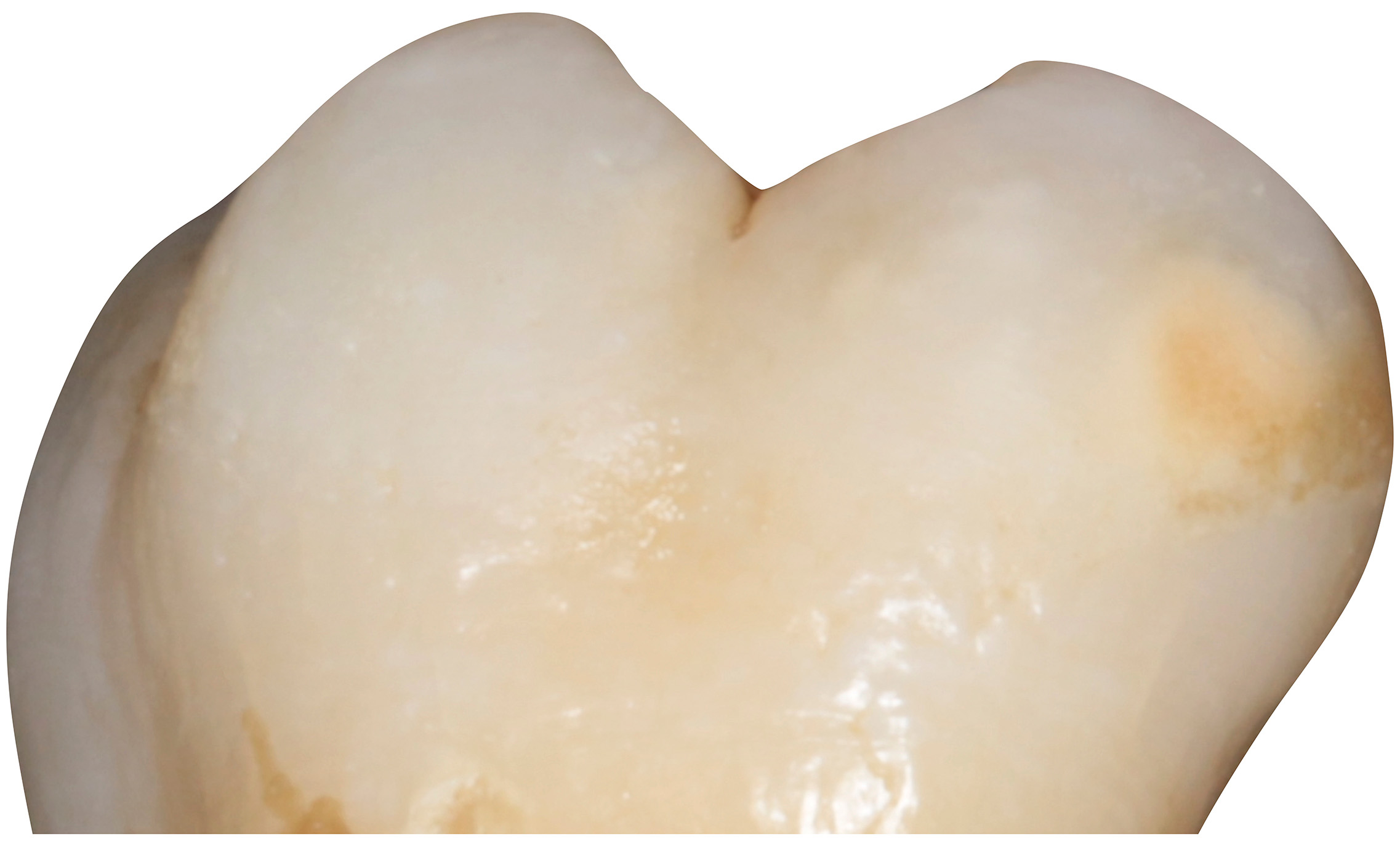 An example of mild form of MIH.