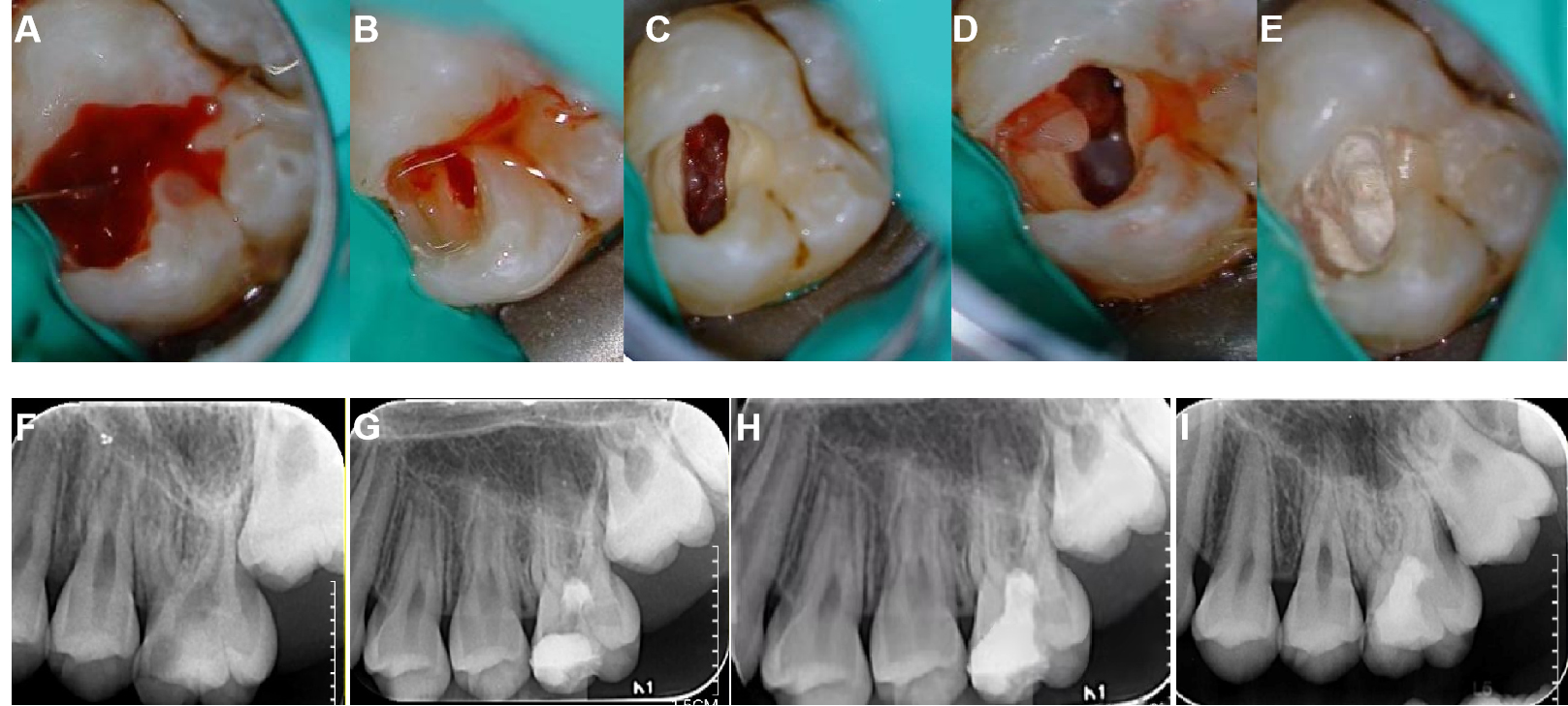 Typical case of a male patient aged 10 years with a maxilla left 
first molar exposed to dental caries with immature roots. (A) pulp exposure after 
caries excavation (B) Rubber dam isolation and caries excavation under 
microscope. (B–D) Removal of inflamed pulp and pulp state evaluation under 
microscope. (E) Pulp capping using iRoot BP Plus. (F) The preoperative periapical 
radiograph. (G) The postoperative periapical radiograph when pulpotomy was 
completed using iRoot BP Plus. (H) The 6-month follow-up. (I) 12-month follow-up 
indicating continuous root growth.
