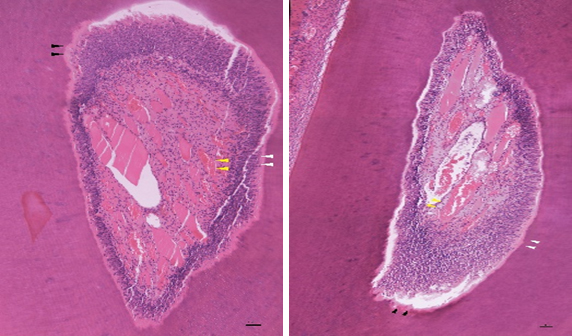 Histological appearance
in Ca(OH)2 group after 8 weeks. Representative photomicrographs showing the
fresh pulp tissue. H&E stain ×200 magnification. Arrows indicate the
tissue beneath the perforating hole.