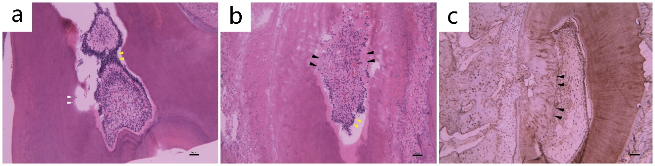 Histological appearance
in Ca(OH)2 group after 8 weeks. Representative photomicrographs showing (a)
large massive inflammatory cell infiltration; (b) necrosis of the coronary pulp
tissue; (c) local calcification and atresia. H&E stain and immunohistochemical
stain ×200 magnification. Arrows indicate the tissue beneath the
perforating hole.