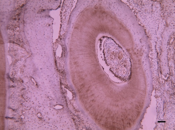 Expression of DSPP beneath
the perforating hole in the specimen with dentin-like tissue formation.
Immunohistochemical stain ×200 magnification.