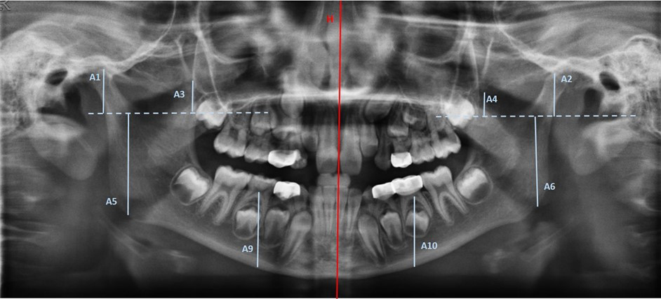 Vertical linear measurements made in the OPG from a 9 years/1
month boy.