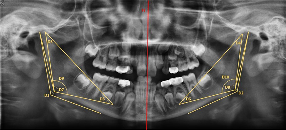 Angular measurements made in the OPG from a 9 years/1 month
boy.