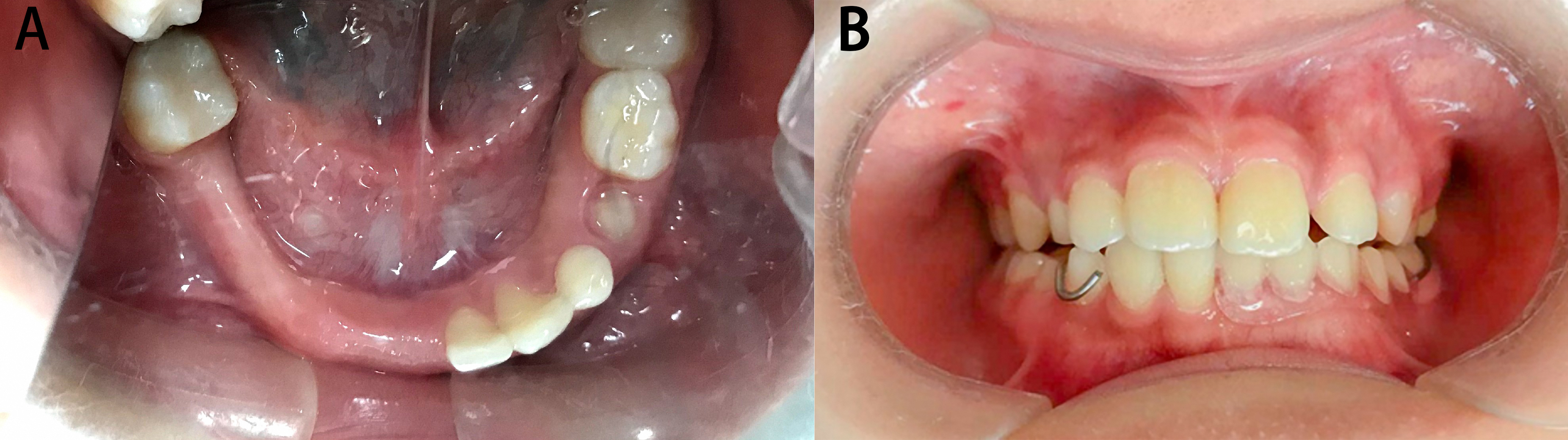 Intraoral view of the 
mandibular arch. A: Before rehabilitation. B: After partial removable denture 
restoration.