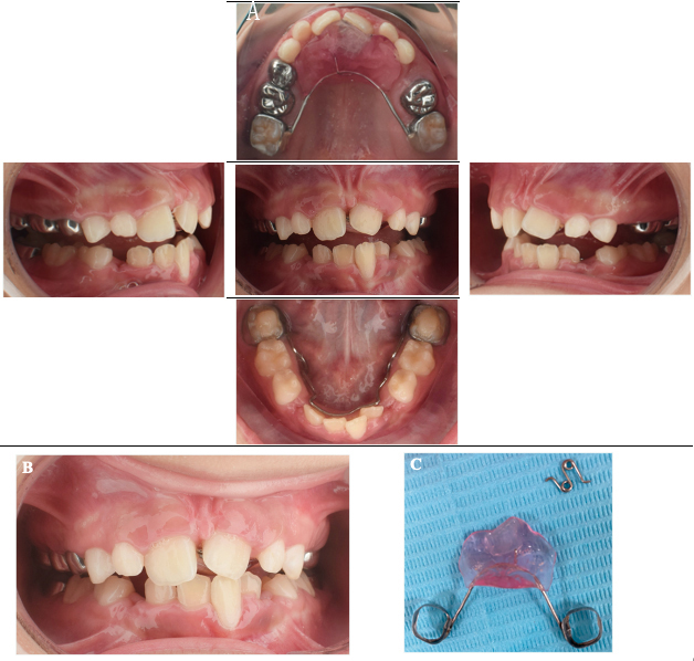 Intraoral clinical pictures at the one-month follow-up visit. (A) Insertion of the maxillary nance appliance with Z spring and lower lingual 
holding arch after the extraction of mandibular primary canines, (B) One-month 
follow-up visit, in which the occlusal composite turbo and the Z spring in the 
nance appliance were removed, and the nance appliance was re-cemented as a space 
maintainer. (C) The Z spring in the nance appliance was 
removed.