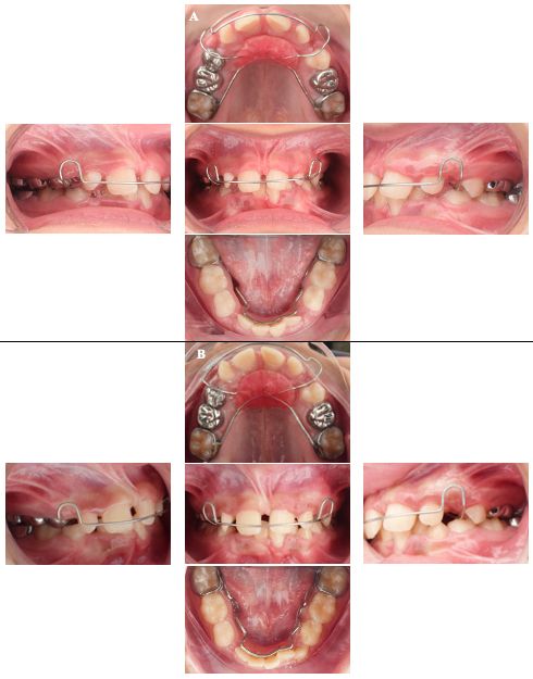 Intraoral clinical pictures 
at the 15- and 24- month follow-up visits. (A) At the 15-month follow-up visit, 
the primary maxillary canines were extracted; labial bows were attached to the 
nance appliance, (B) At the 24-month follow-up visit.