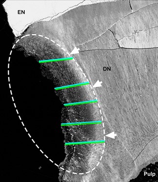 Image of BSE-SEM micrographs with visible evidence of 
differences in mineral density. A caries lesion after exposure to SDF (group 1) 
is enclosed by the dashed line, surrounded by sound dentin and away from the pulp 
tissue. A dense white hypermineralization area is noted at the deepest portion of 
the lesion (white arrows). Green lines follow the orientation of the lesion, and 
correspond to the depth of silver penetration, overlapping on blue lines where 
depth of the lesion was measured. EN is enamel and DN is dentin.