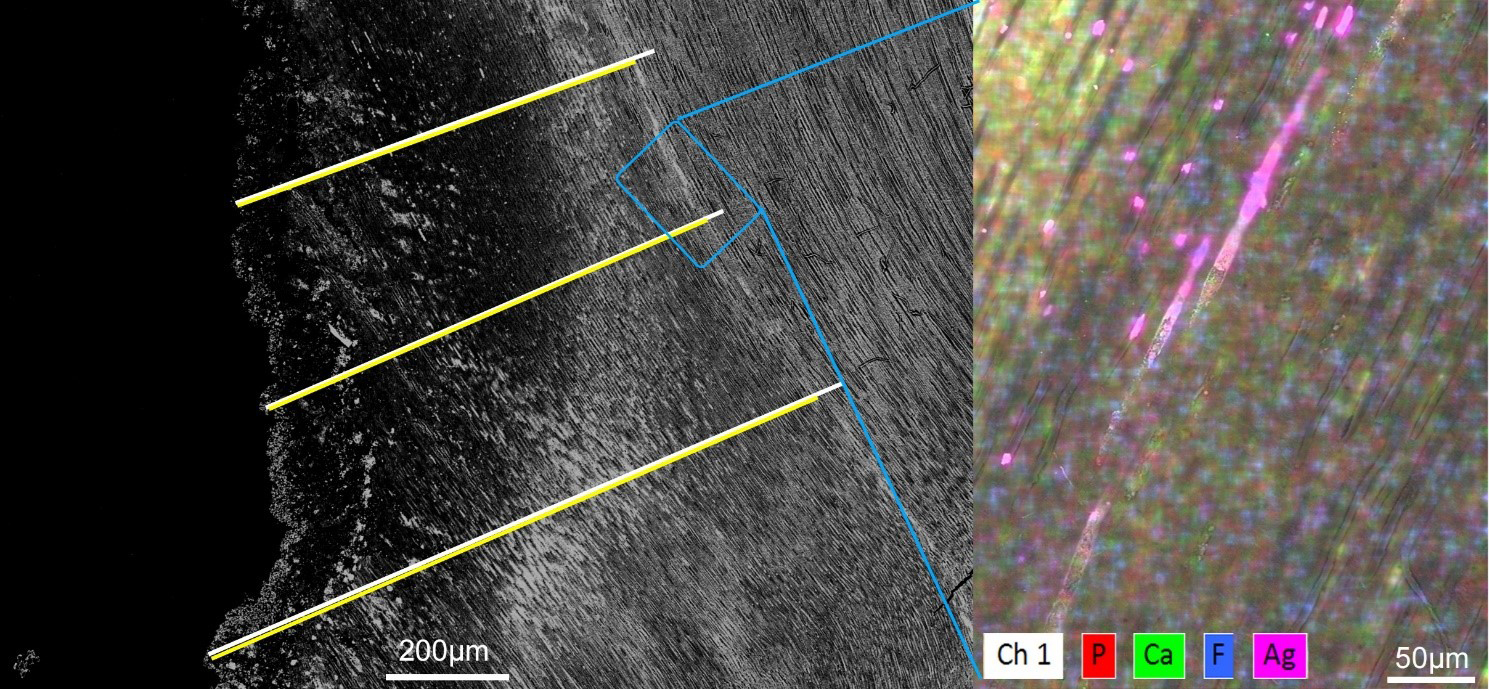 Left side is a magnified view of a representative sample of a 
Group 1 lesion showing 3 sites out of the 5 measurements taken. Yellow lines 
marking silver penetration, overlapping on white lines marking depth of the 
lesion. Blue rectangle denotes the area where EDS analysis was done. EDS analysis 
(right side) was used to confirm the minerals present in the dentin at the 
deepest area of silver penetration. Pink color denotes presence of silver (Ag), 
and yellow areas are an overlap of green and red, indicating areas with where Ca 
and P are prevalent.