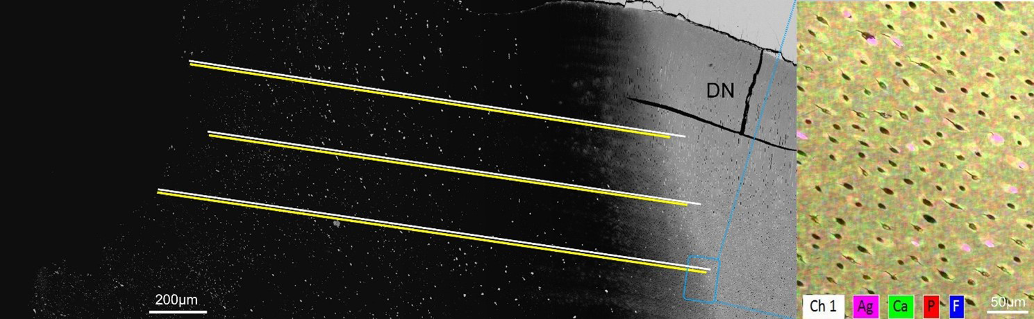 Left side is a magnified view of a representative sample of 
Group 2 lesion showing 3 sites out of the 5 measurements taken. Yellow lines 
marking silver penetration, overlapping on white lines marking depth of the 
lesion. Blue rectangle denotes the area where EDS analysis was done. EDS analysis 
(right side) was used to confirm the minerals present in the dentin at the 
deepest area of silver penetration. Pink color denotes presence of silver (Ag), 
and yellow areas are an overlap of green and red, indicating areas with where Ca 
and P are prevalent, DN is sound dentin.