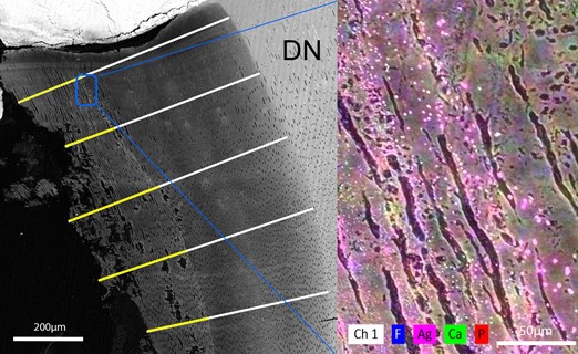 Left side is a magnified view of a representative sample of 
Group 3 lesion showing 3 sites out of the 5 measurements taken. Yellow lines 
marking silver penetration, overlapping on white lines marking depth of the 
lesion. Blue rectangle denotes the area where EDS analysis was done. EDS analysis 
(right side) was used to confirm the minerals present in the dentin at the 
deepest area of silver penetration. Pink color denotes presence of silver (Ag). 
DN is sound dentin.