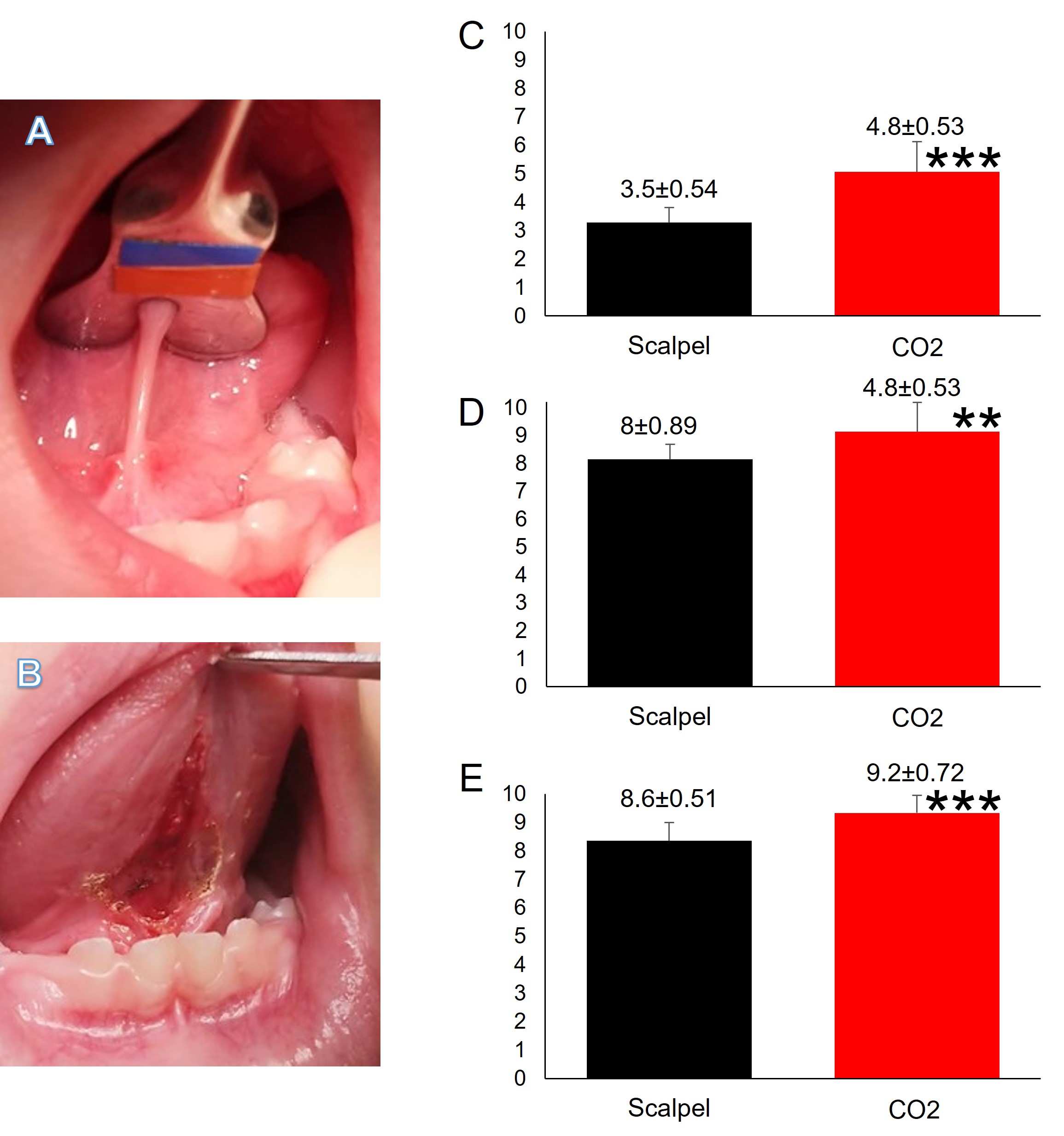 Lingual frenectomy evaluation of patient perception. (A) 
Clinical photography of a Class IV attached lingual frenulum. (B) Clinical 
photography immediately after surgery with CO2 laser. (C) Pain score by VAS. 
(D) Improvement score by VAS. (E) Satisfaction score by VAS. **p < 
0.01, ***p < 0.001.