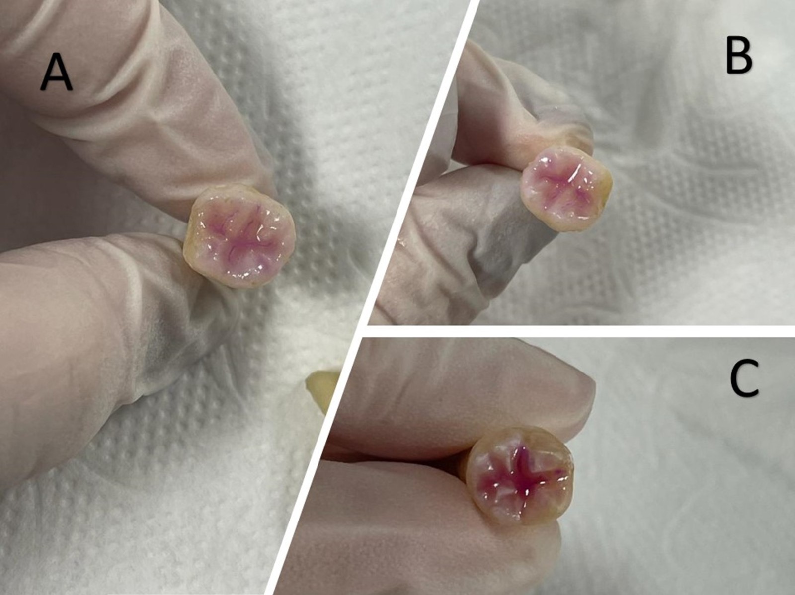 Following three preparation techniques, the occlusal fissures of 
the teeth were occluded with Denfil Flow (Vericom Co., Ltd., Korea) flowable 
composite resin. (A) Enameloplasty, (B) Conventional, (C) Fissurotomy.