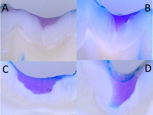 Scoring criteria established by Grande. (A) Score 0: No dye 
penetration. (B) Score 1: Dye penetration up to 1/3 of the fissure depth. (C) 
Score 2: Dye penetration greater than 1/3 and less than 2/3 the depth of the 
fissure. (D) Score 3: Dye penetration greater than 2/3 of the fissure depth.