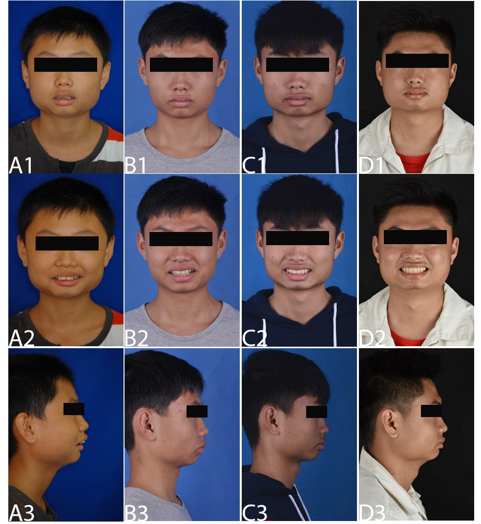 Facial photographs of the patient. (A1–A3) before treatment; (B1–B3) at posttreatment of phase I;
(C1–C3) at posttreatment of phase II; and (D1–D3) at 7-year follow-up.