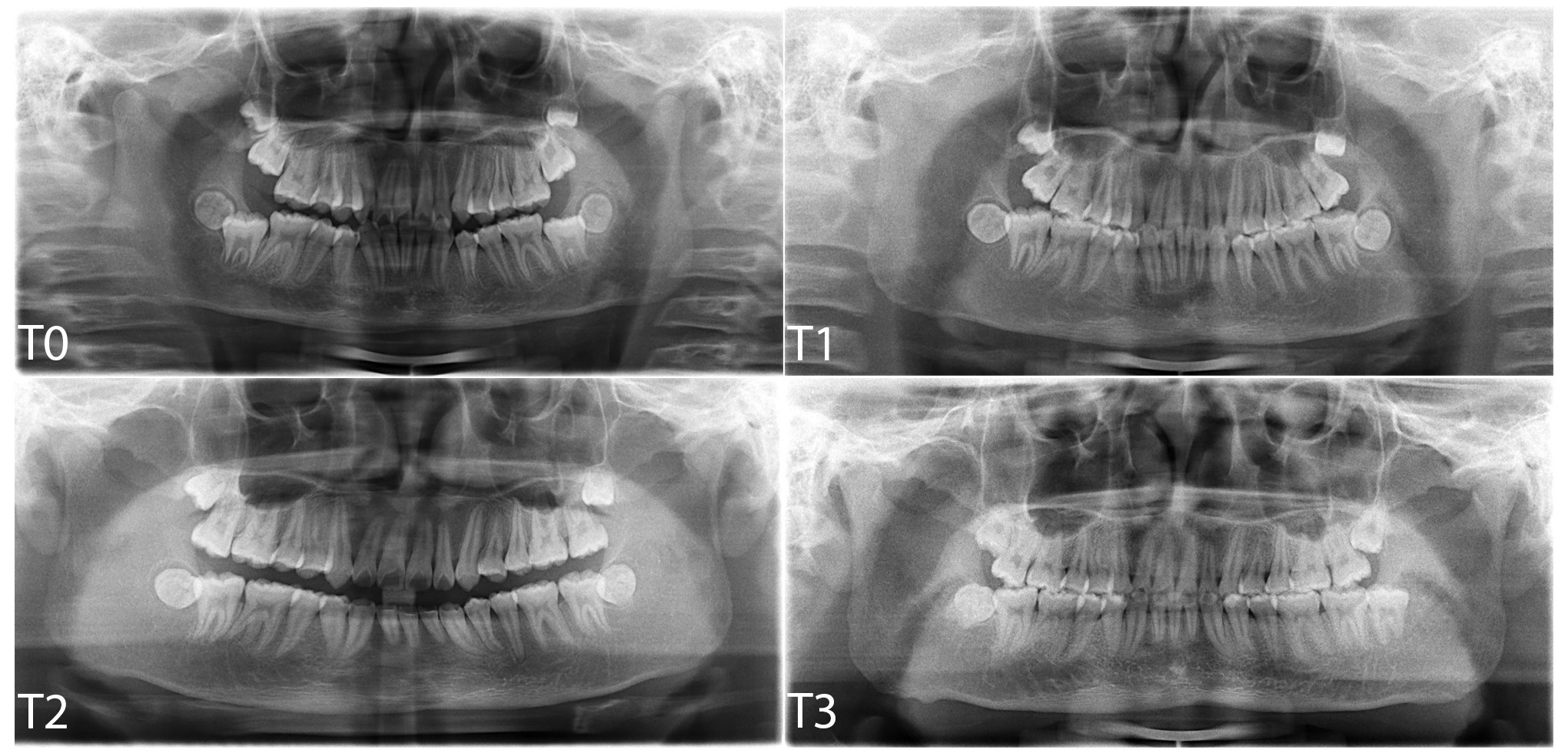 Panoramic radiograph of the
patient. (T0) before treatment; (T1) at posttreatment of phase I; (T2) at
posttreatment of phase II; and (T3) at 7-year follow-up.
