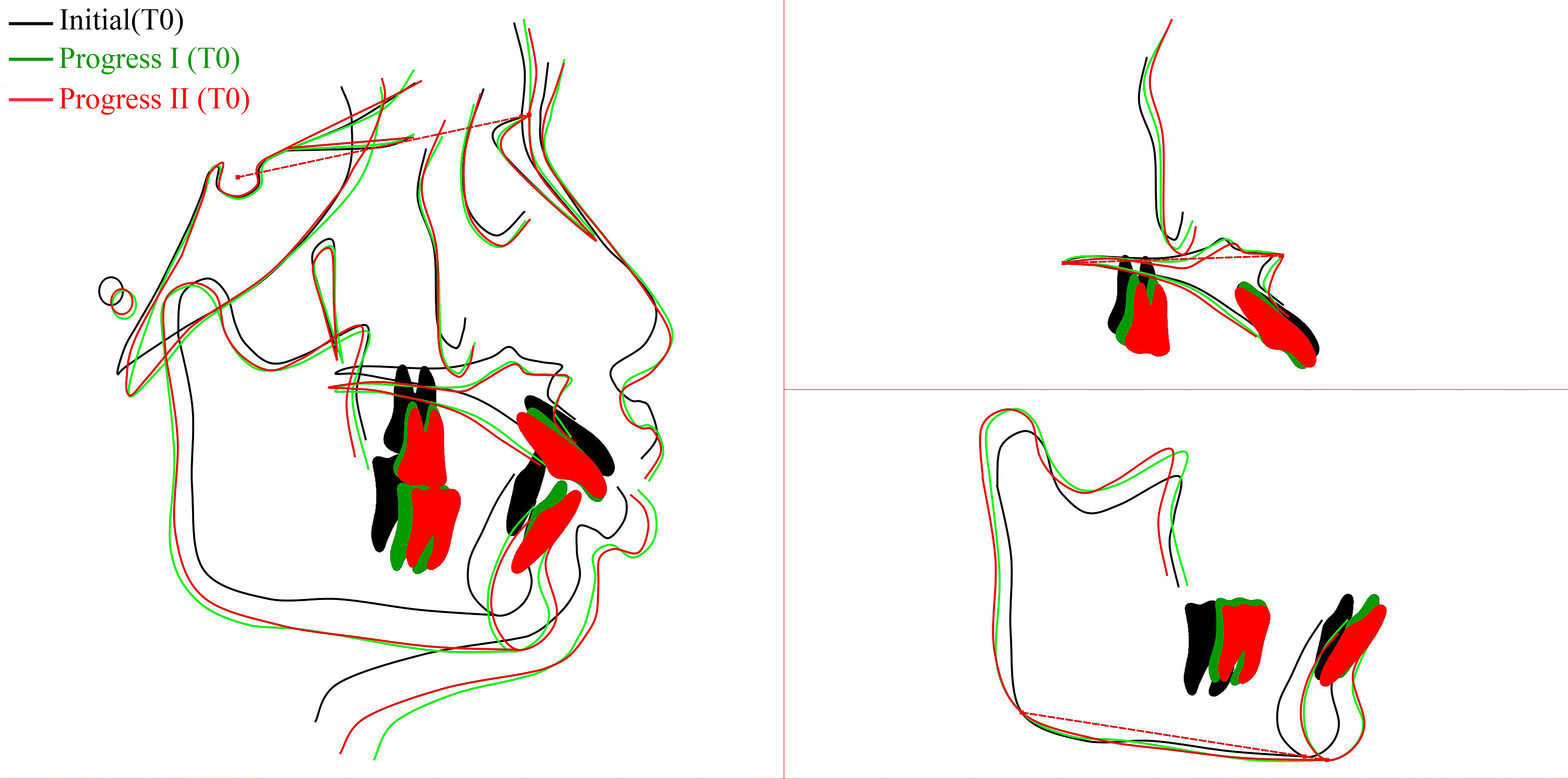 Superimposed lateral
cephalograms.