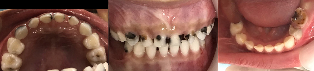 Initial intraoral clinical examination showed multiple dental
caries with unrestorable of primary mandibular left first and second molar.