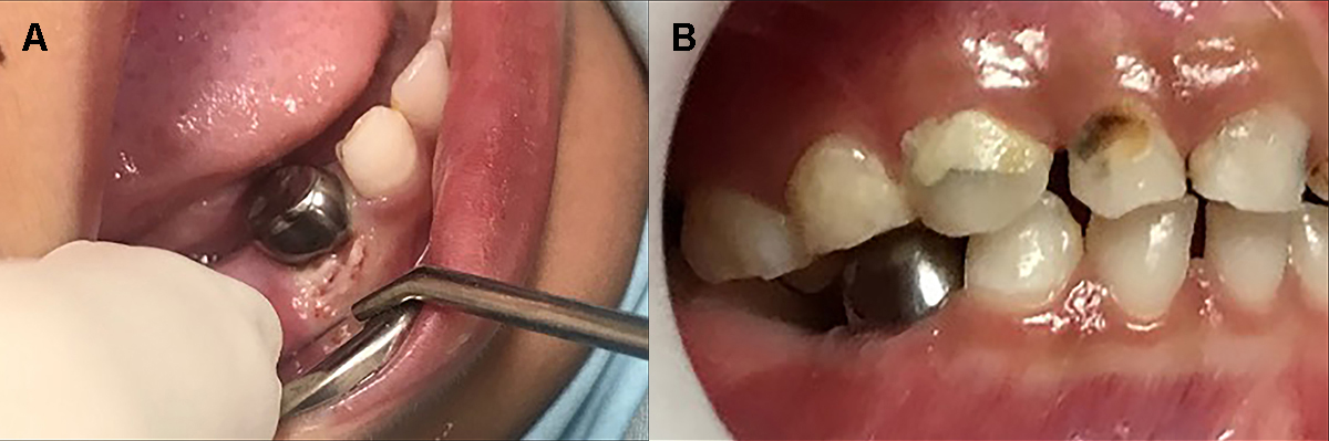 Oral manifestations presented with stomatitis and mucositis,
erythema lips and mucosa, dry and cracked lips.
