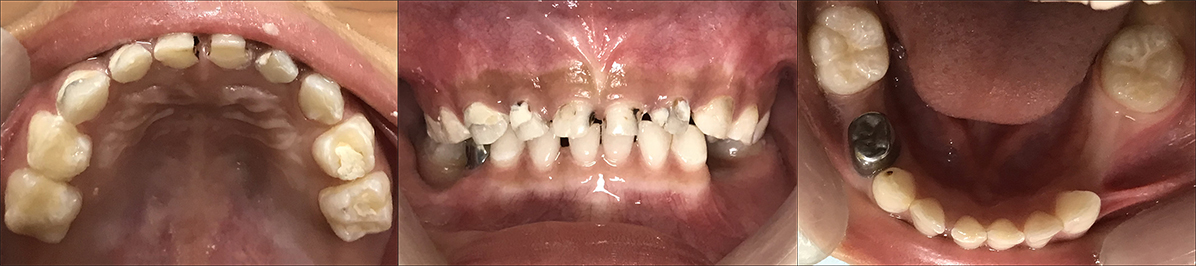6 months follow up intraoral examination.