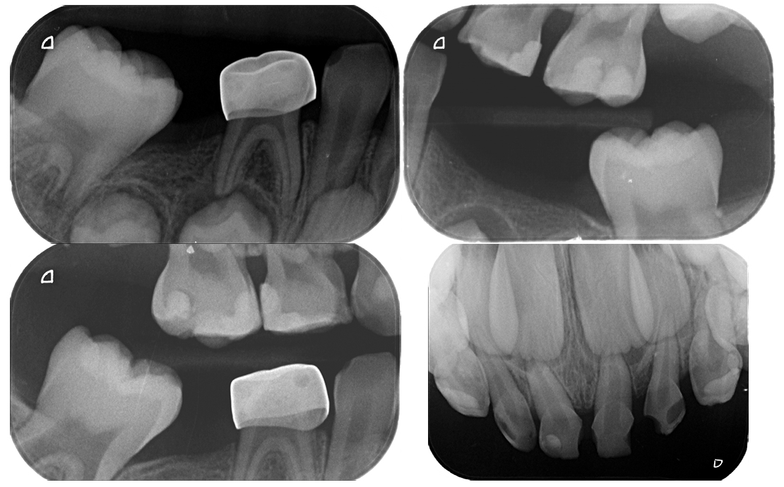 6 months follow up radiographic images.