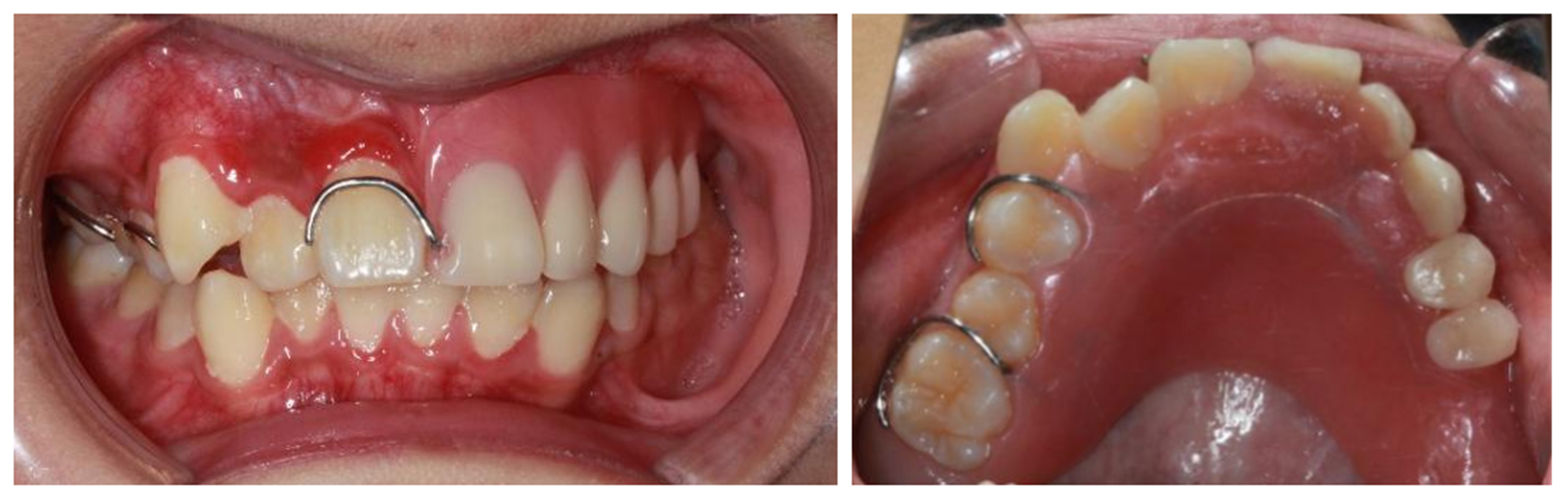 Buccal and occlusal view of 
the removable partial oral dentures.