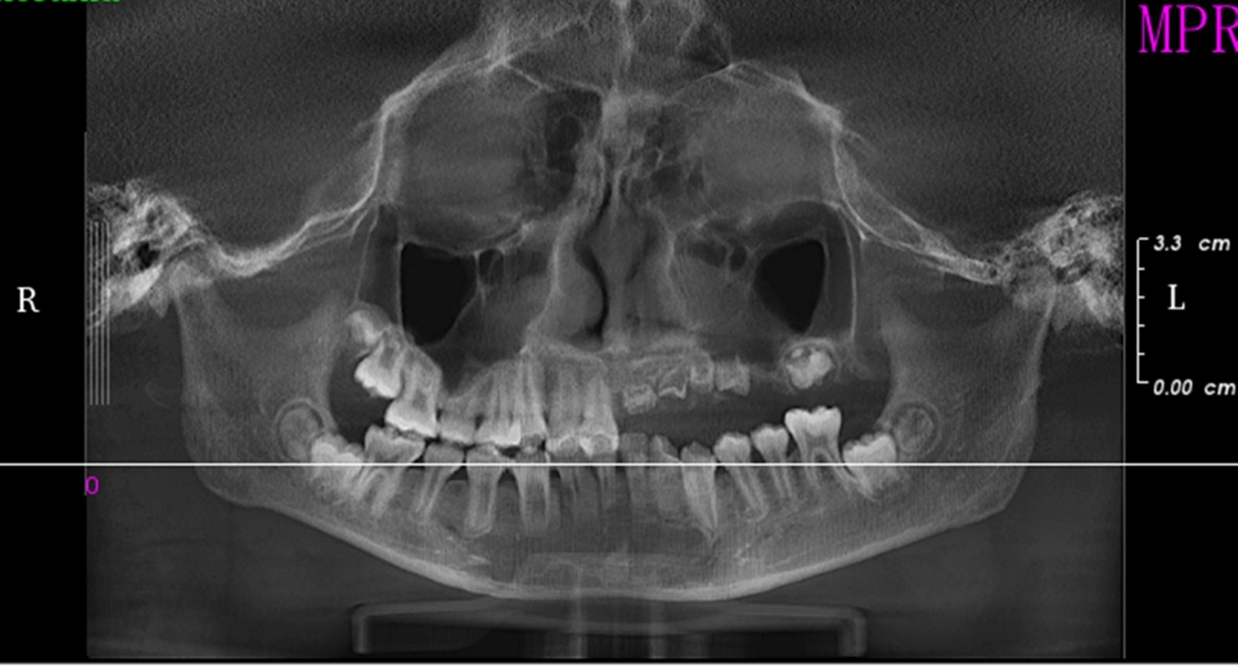 CBCT showing no significant 
development of the left maxillary permanent tooth embryo and a slight increase in 
density. However, the hard tissues remained thin, with a wide pulp chamber, 
demonstrating a “ghost-like” appearance.