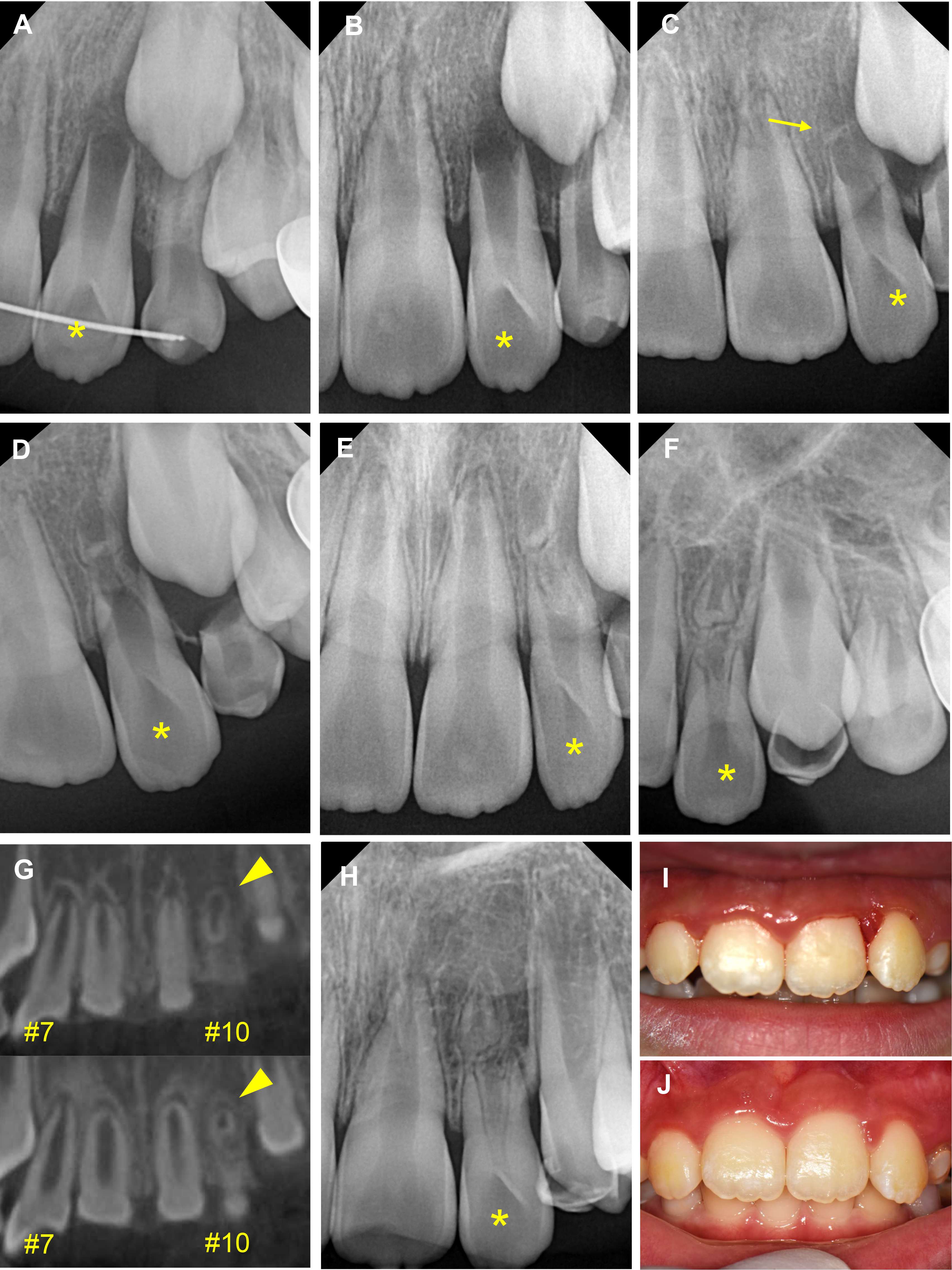 Serial radiographs and clinical photos of case 1. (A) The first
radiograph of the splinted left upper lateral incisor. (B–E) Radiographs at the
4-week, 6-week, 3-month and 6-month follow-ups. Yellow arrows indicate the
unknown radiopaque tissue around the apical area. (F,G) Radiograph and cone-beam
computed tomography (CBCT) images at the 1-year follow-up. The arrowhead
indicates the apical area of the separated root tip of the left upper lateral
incisor. (H) A radiograph at the 17-month follow-up. (I,J) Clinical photos at the
first visit and the 17-month follow-up.