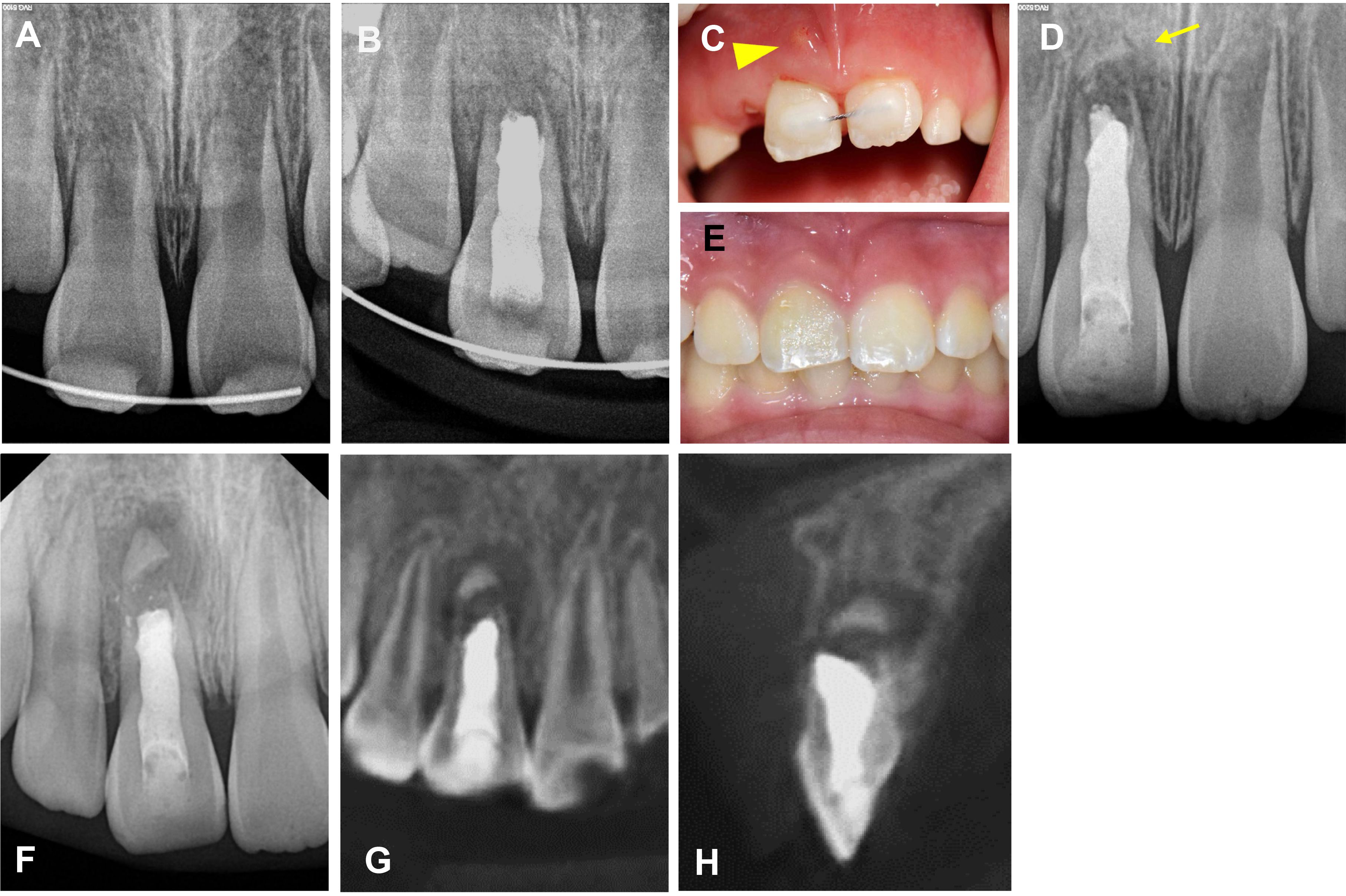Serial radiographs and clinical photographs of case 2. (A) A
radiograph immediately after repositioning and splinting of the traumatic right
upper central incisor. (B) Postoperative periapical radiograph after a one-visit
apexification. (C) Clinical photograph 1 month after apexification. The arrowhead
indicates the sinus tract. (D) Radiograph 3 months after apexification. The
yellow arrow indicates radiopaque tissue, located apically from the radiolucency.
(E) Clinical photo 3 years from the apexification. (F–H) Radiograph and
cone-beam computed tomography (CBCT) images 3 years from the apexification.