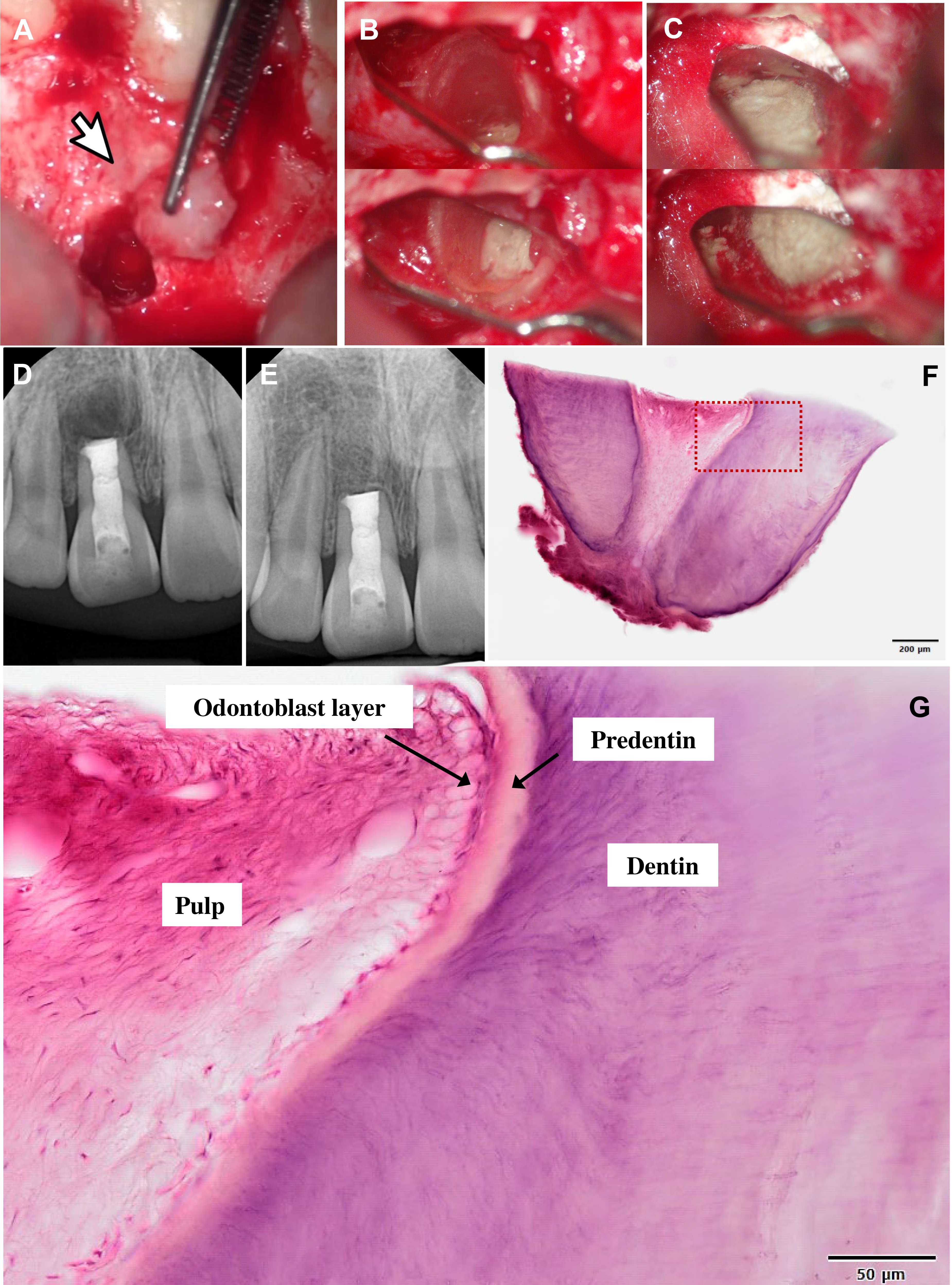 Clinical photographs and radiographs and histologic images of
case 2. (A) Hard tissue taken during surgery (arrow). Clinical photographs of
(B) root preparation and (C) root-end filling using RetroMTA. (D,E) A
postoperative radiograph (D) immediately and (E) 1 year after the surgery. (F)
Haematoxylin and eosin (H&E) staining of the hard tissue of (A). (G) High
magnification of dotted square of (F).